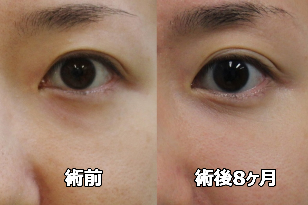 ★393 34歳女性　経結膜脱脂術+眼窩脂肪注入（クマ治療）