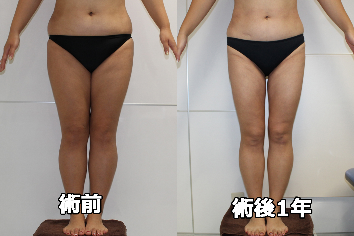 【他院術後】大腿★105-2 39歳女性 大腿臀部膝周りVASERアキーセル脂肪吸引　1年後