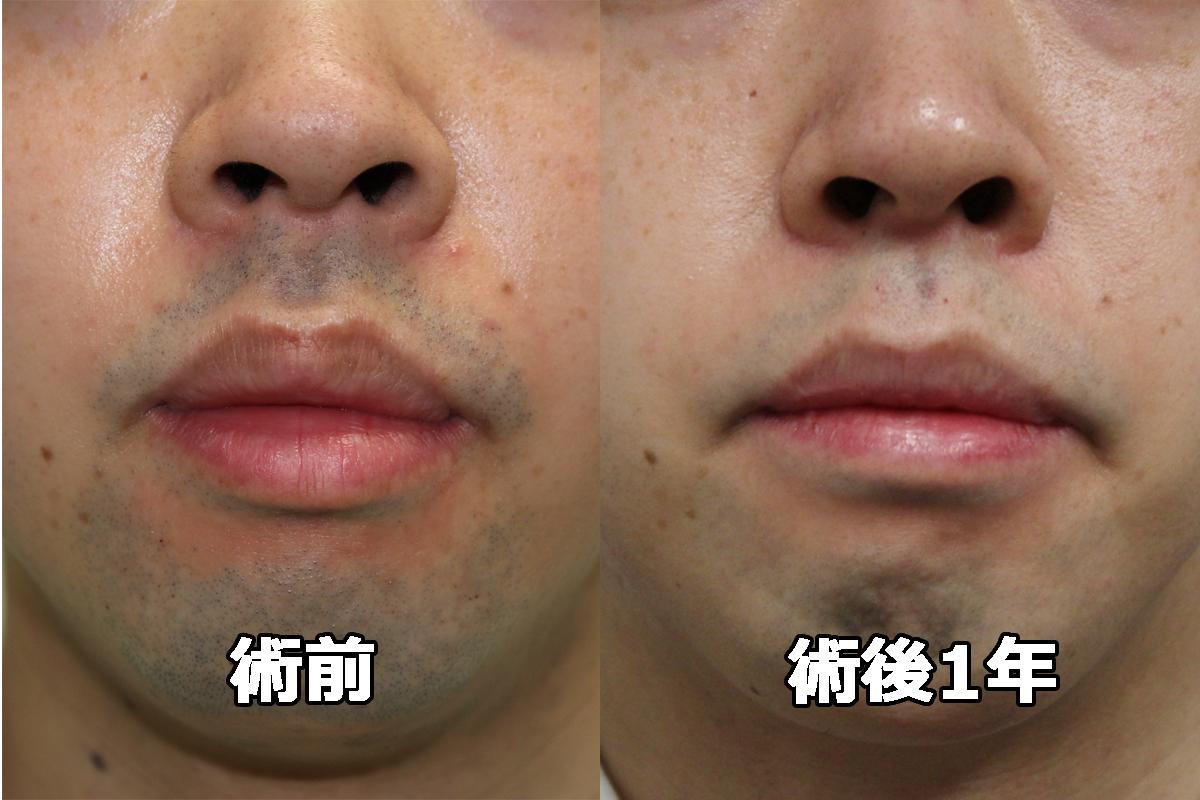 【術後1年】★12-2　28歳男性　唇を薄くする手術（口唇縮小（上下））
