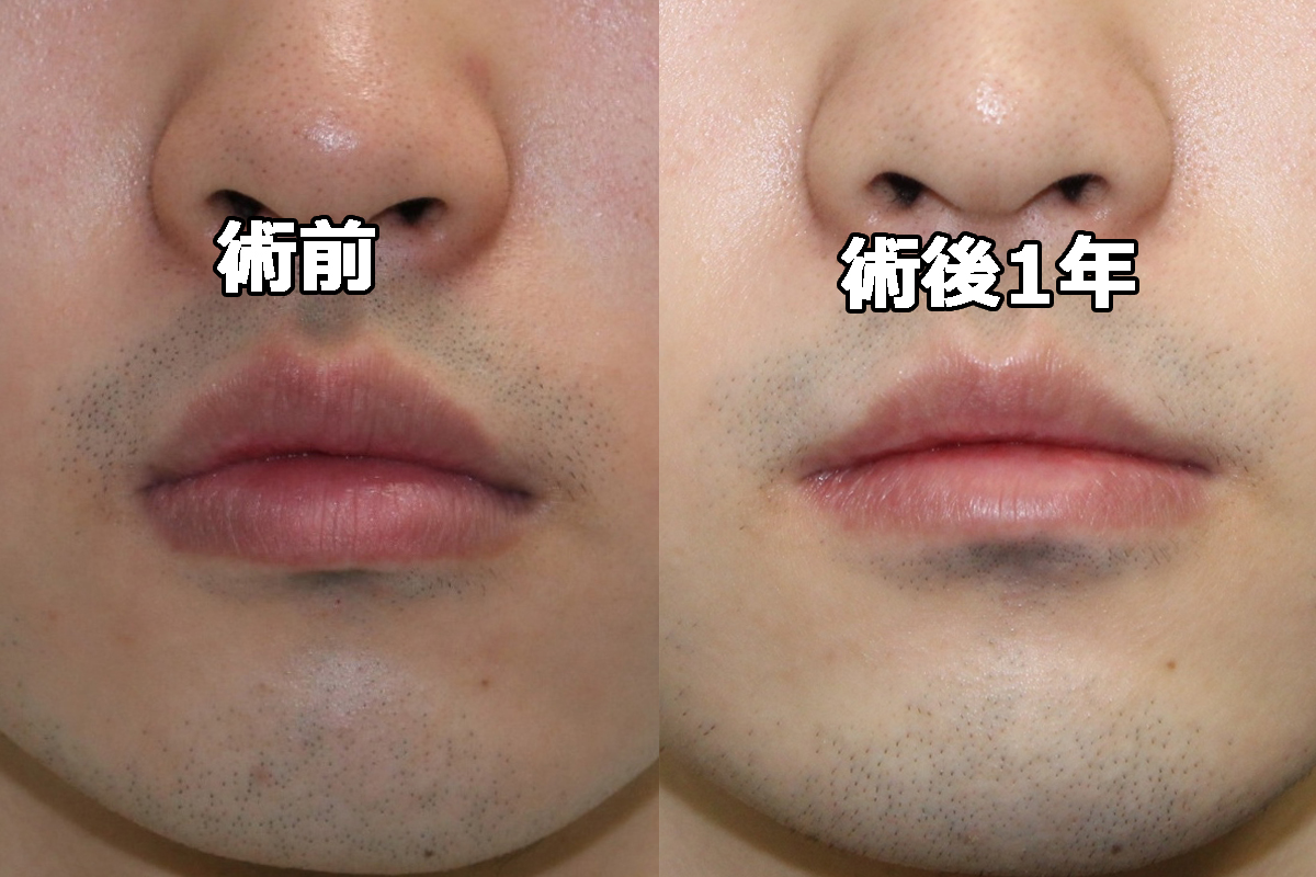 ★13-2　22歳男性　唇を薄くする手術（口唇縮小（上下））　術後1年