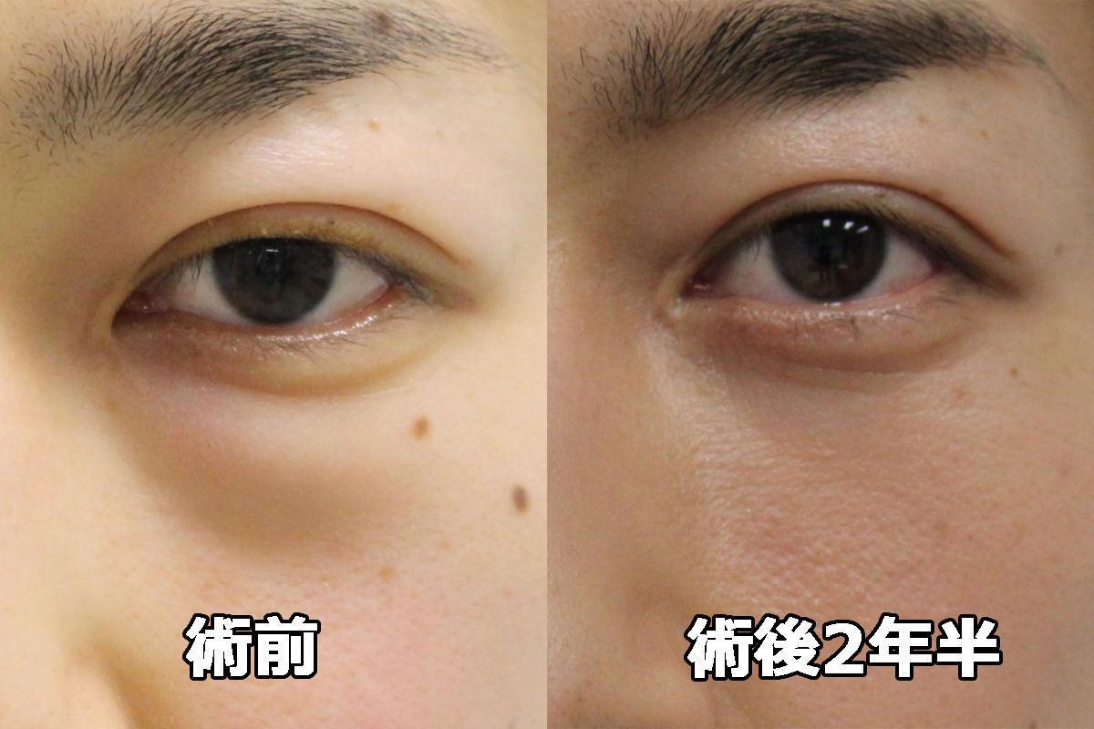 【術後2年半】★224-2　26歳男性　経結膜脱脂術+眼窩脂肪注入