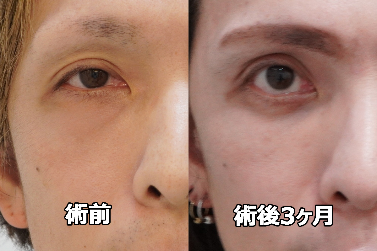 ★396 40歳男性 経結膜脱脂術+眼窩脂肪注入　鼻が高くなった！！