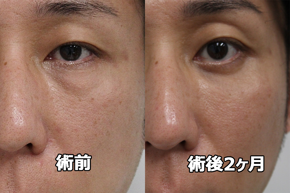 ★403　42歳男性 経結膜脱脂術+マイクロCRF（目の下・中顔面）　クマ治療