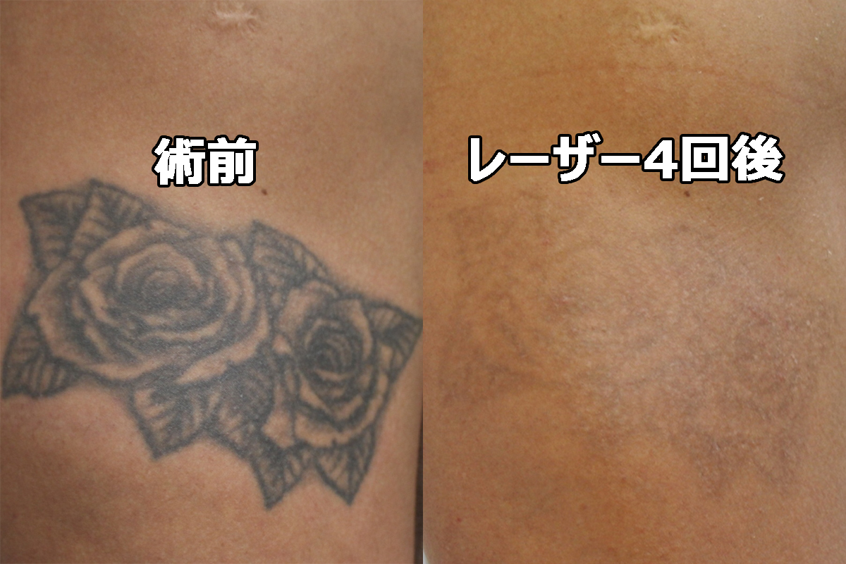 黒単色Tattoo　Q-スイッチYAGレーザー4回