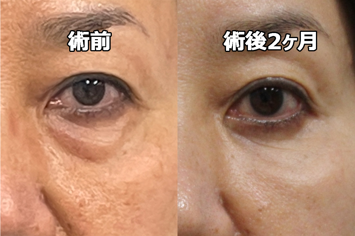★410　56歳女性　経結膜脱脂術+眼窩脂肪注入　クマ治療
