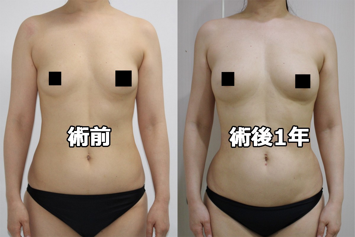 【術後1年】★91-2　45歳女性　腹腰・下背部VASERアキーセル脂肪吸引+CRF豊胸
