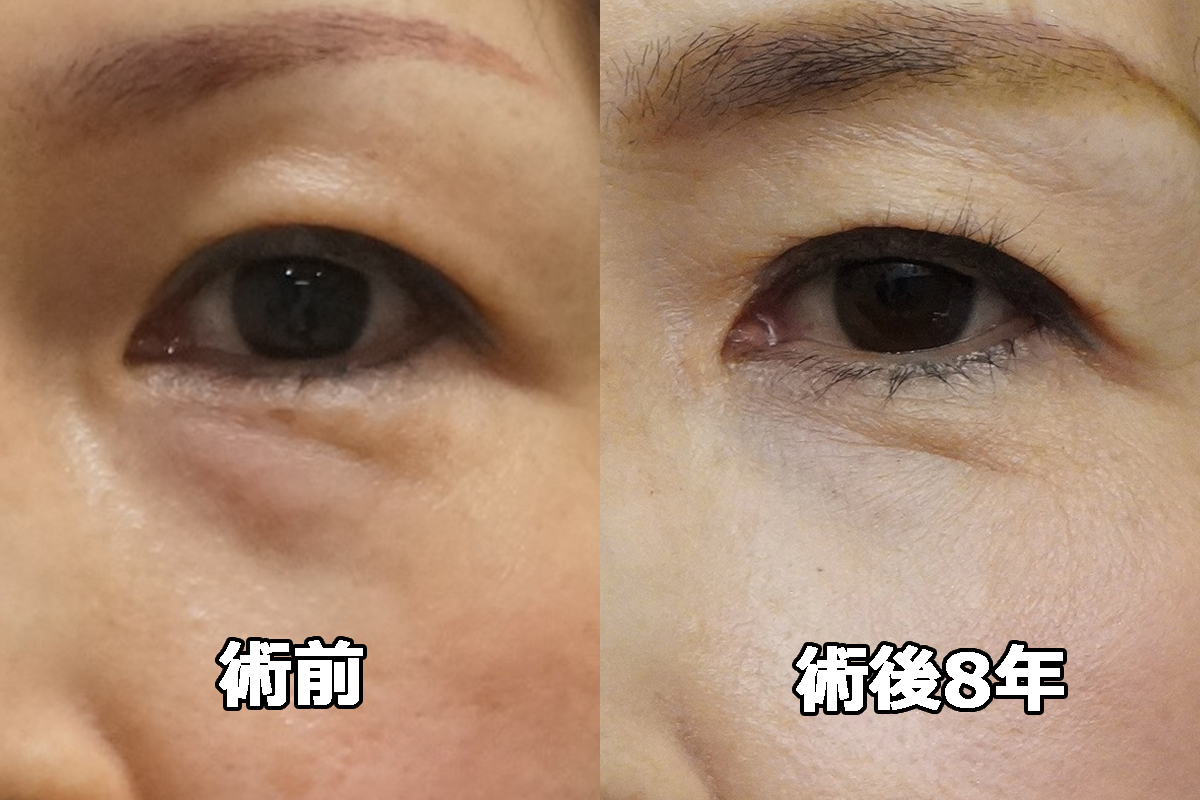 【術後8年】★58　50歳女性　経結膜脱脂術+眼窩脂肪注入　　超長期経過