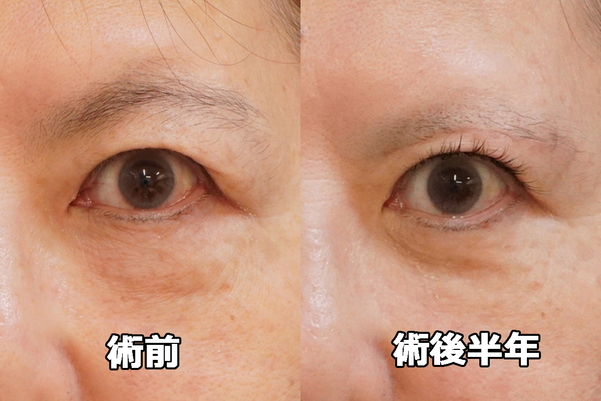 ★418　59歳女性　眉下切開・経結膜脱脂術+マイクロCRF　上眼窩脂肪は下に落ちてこない