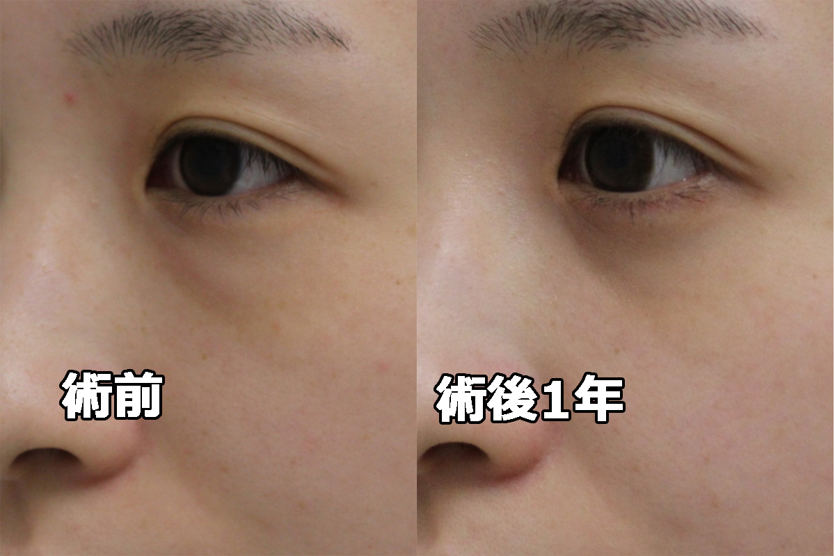 ★430　27歳 経結膜脱脂術+マイクロCRF（目の下中顔面）