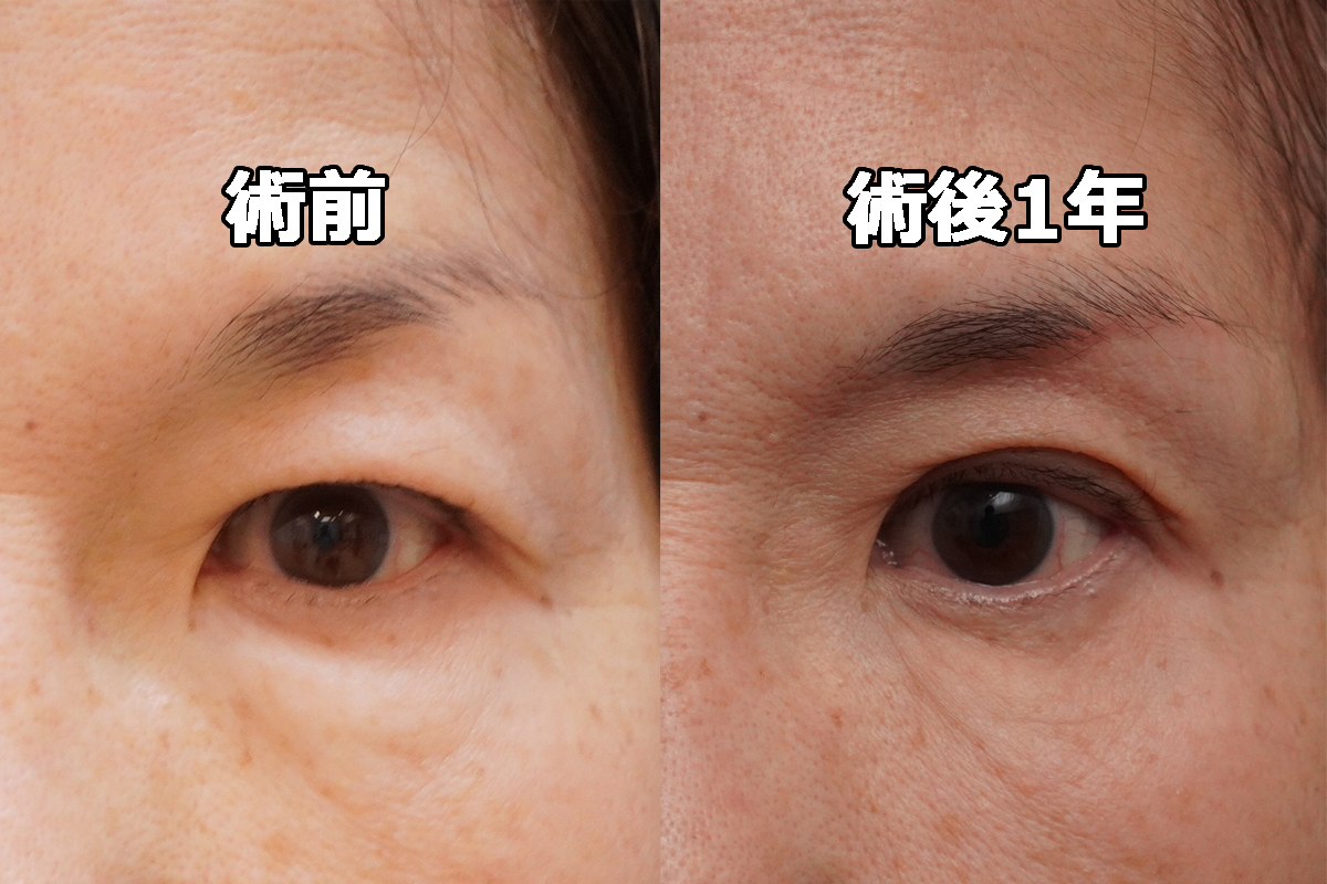 ★431　69歳　経結膜脱脂術+眼窩脂肪注入+眉下切開
