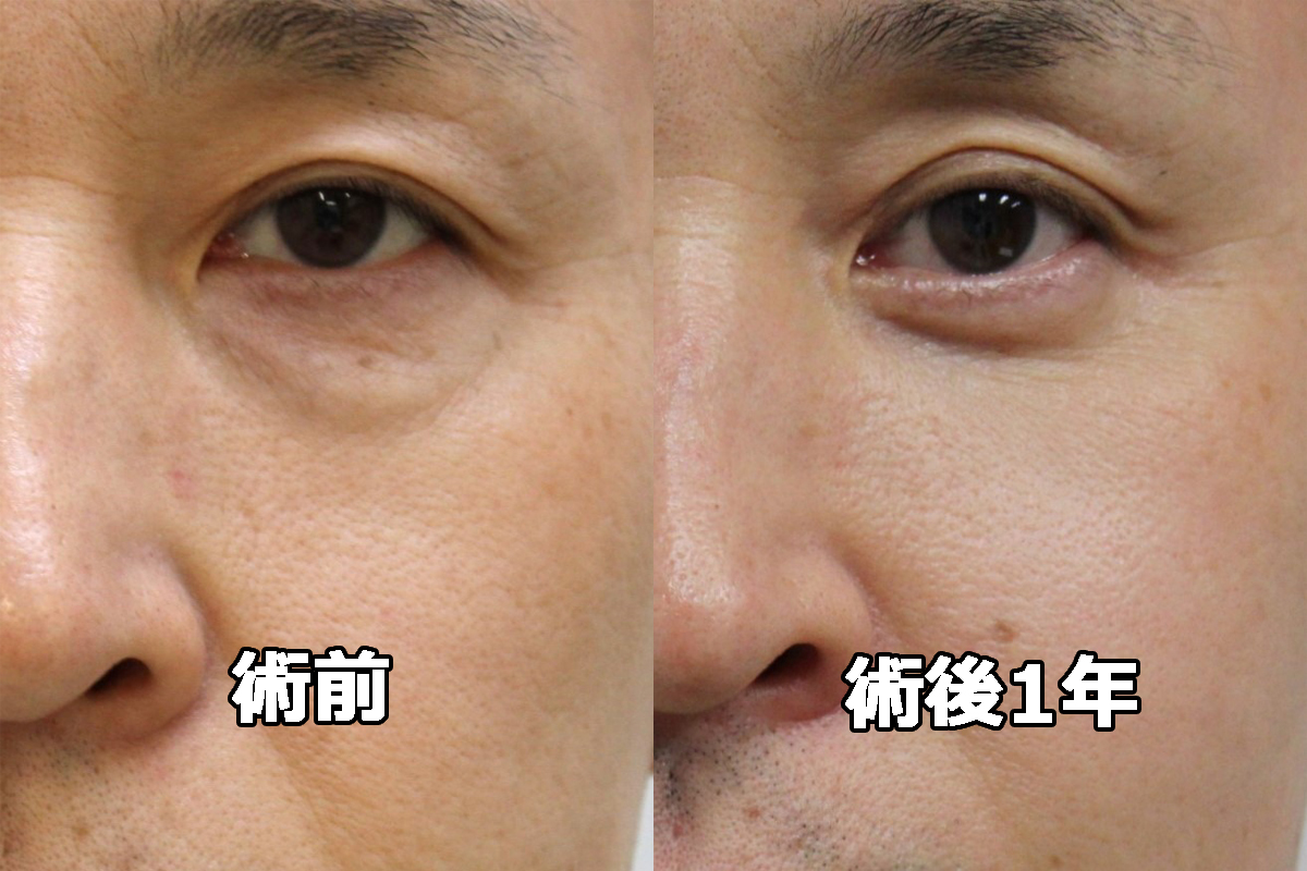 ★433 47歳男性　経結膜脱脂術+マイクロCRF【クマ治療】