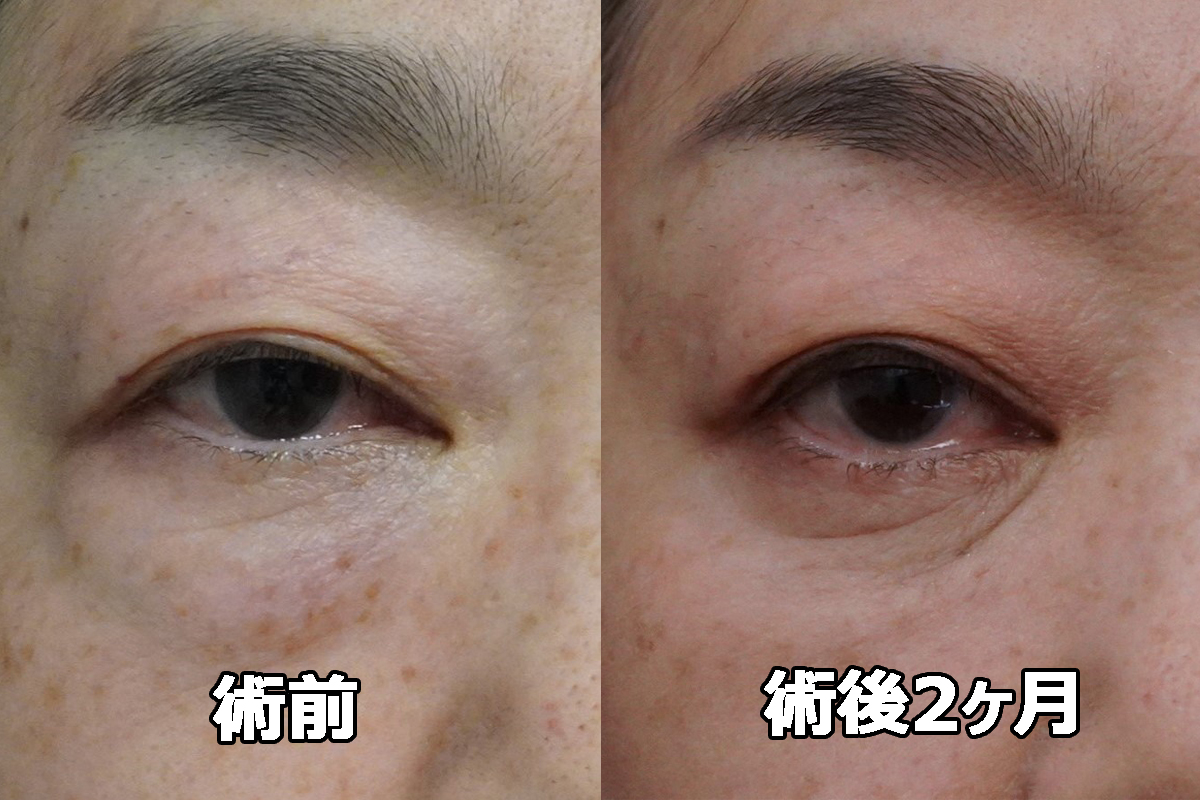 【Basedow病の眼球突出+クマ治療】★435　64歳女性　経結膜脱脂術+マイクロCRF