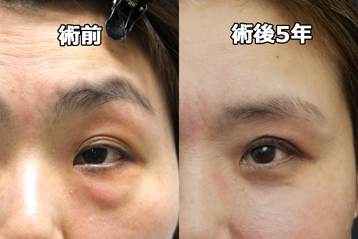 ☆15-3　★181-3　45歳女性 経結膜脱脂術+中顔面など脂注+眉下切開+（プレミアムクイック）