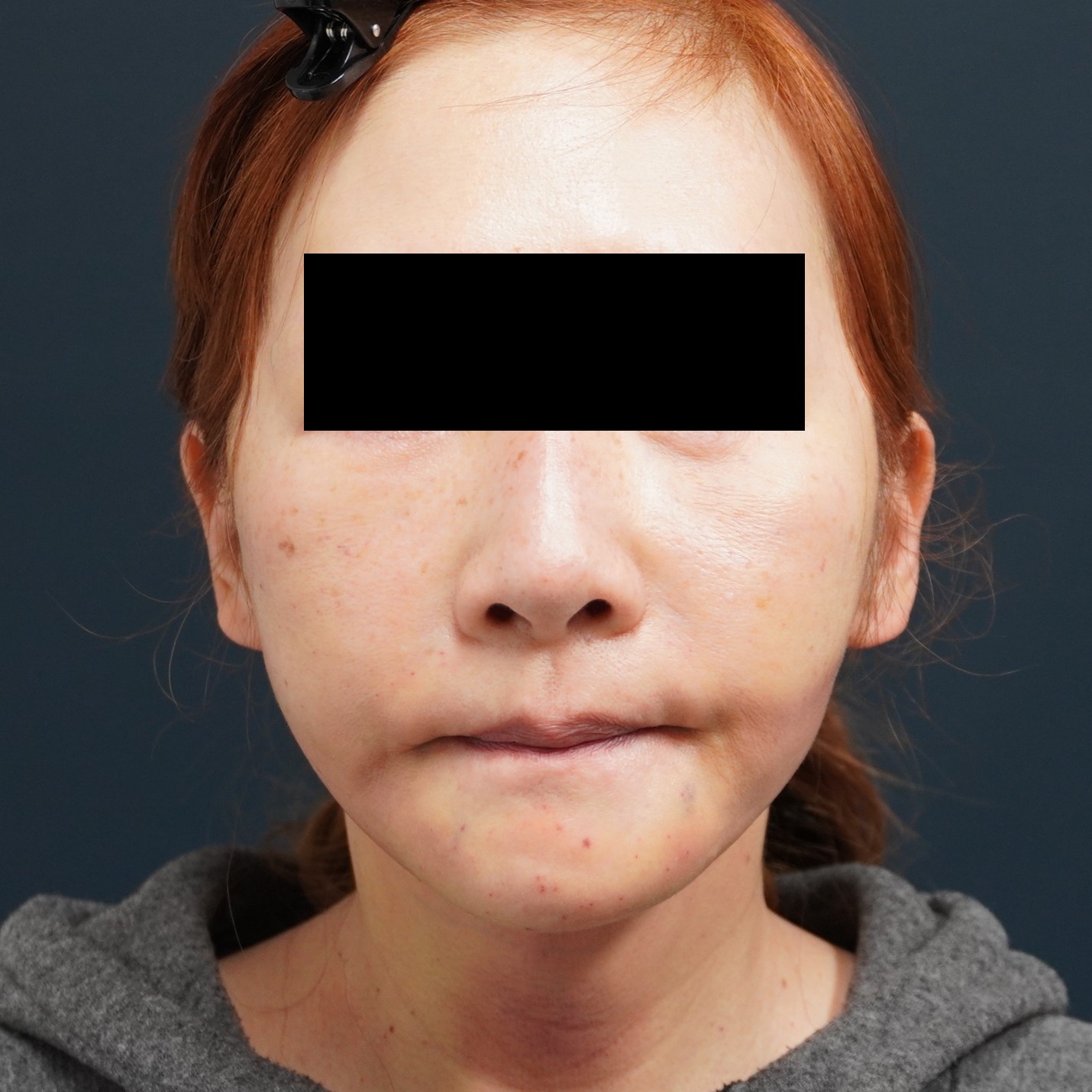 切らないフェイスリフト】☆215 55歳女性 頬アゴ下VASER 切らないフェイスリフト】☆215 55歳女性 頬アゴ下VASER