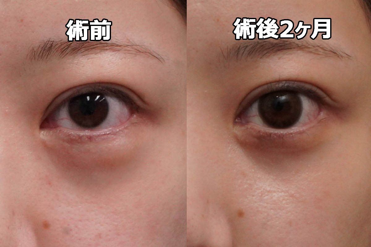 【韓国脂肪再配置修正（裏ハムラ）】★440 25歳女性　経結膜脱脂術+眼窩脂肪注入