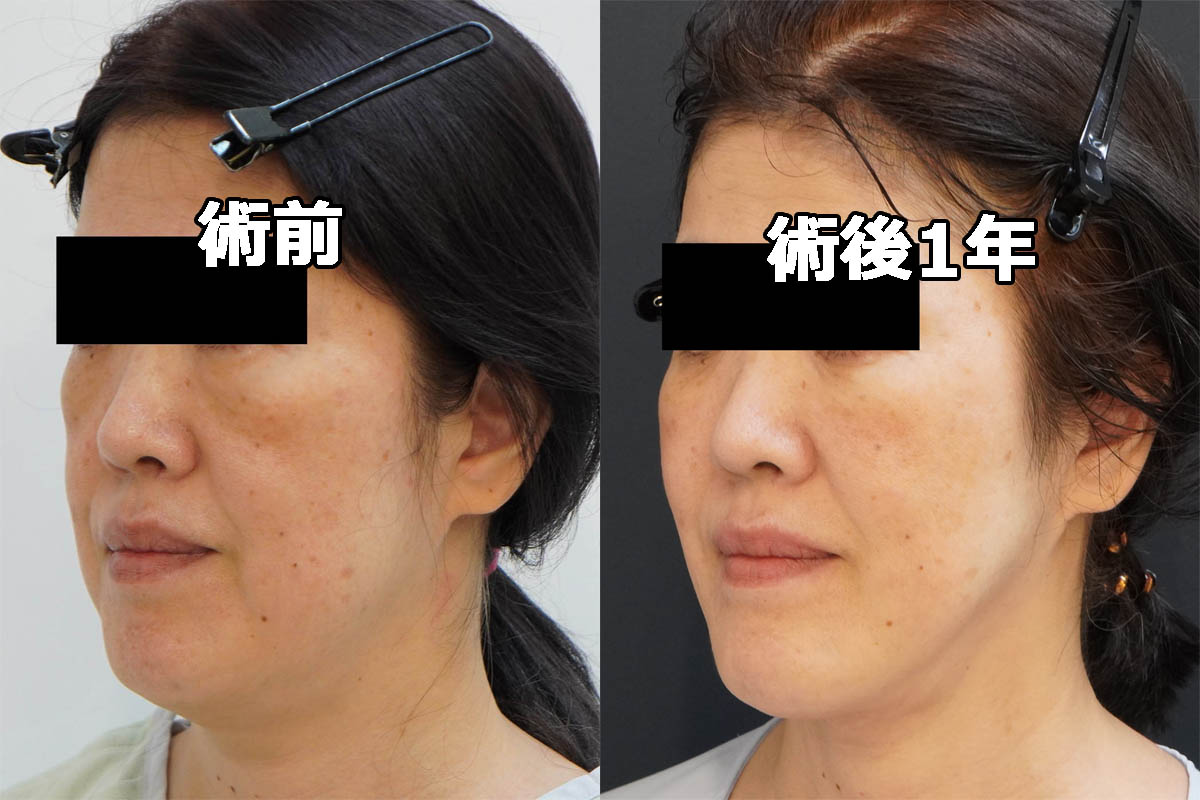 【切らないフェイスリフト】★214 56歳女性 頬アゴ下VASERアキーセル+マイクロCRF+ゴルゴ線剥離