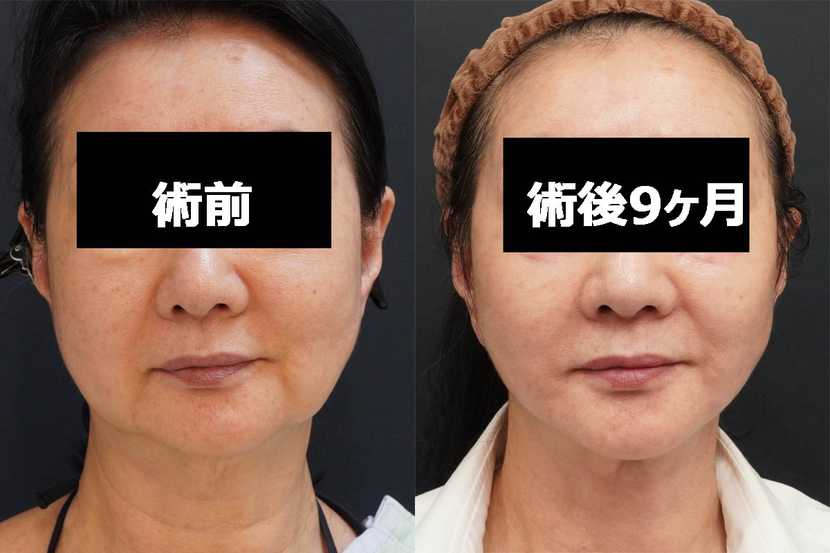 【切るフェイスリフト】★61 71歳女性 シグネチャーリフト+頬アゴ下VASERアキーセル+マイクロCRF