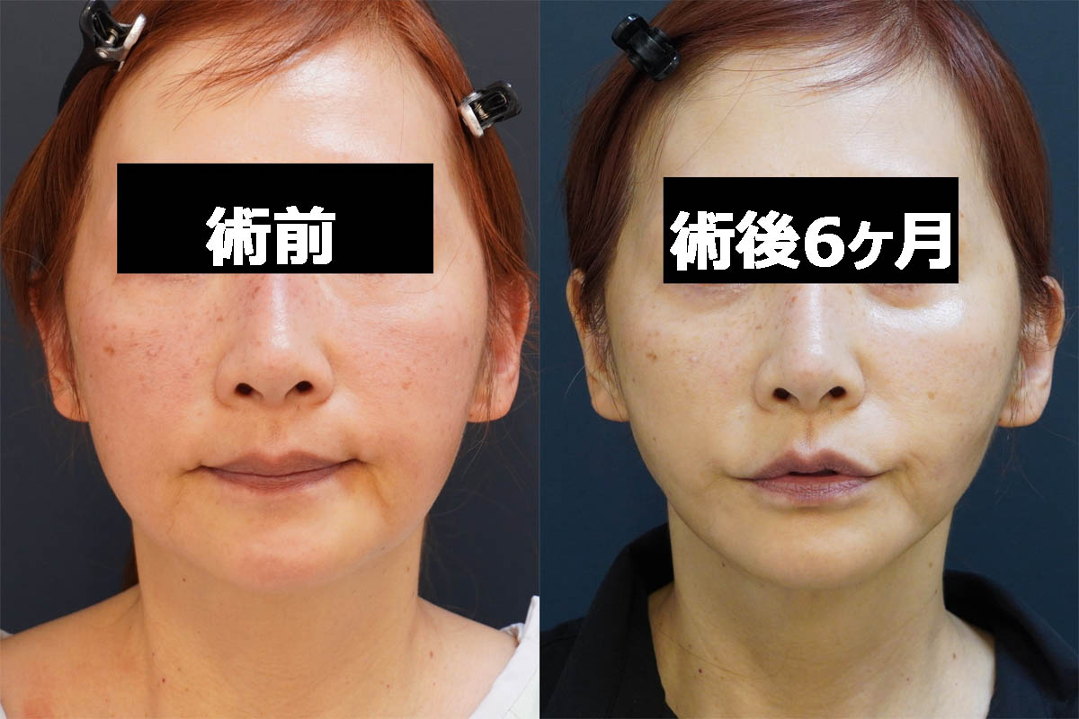【切らないフェイスリフト】★215 55歳女性 頬アゴ下VASERアキーセル+マイクロCRF