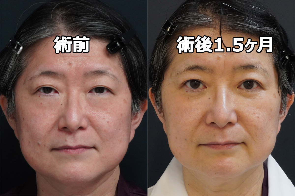 ★441 梁先生59歳の経結膜脱脂術+眼窩脂肪注入+プレミアムクイック（埋没法）