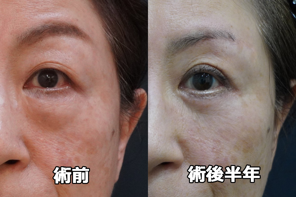 ☆34　★444　61歳女性　経結膜脱脂術+マイクロCRF 下まぶた切開たるみ取り+眉下切開