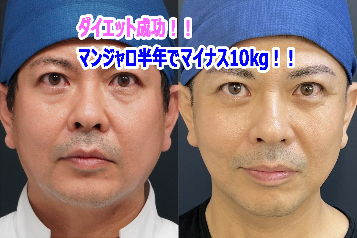 マンジャロ（1週間に1度のGLP-1）で半年10KGダイエット成功！！