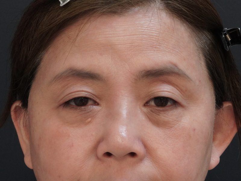 術前