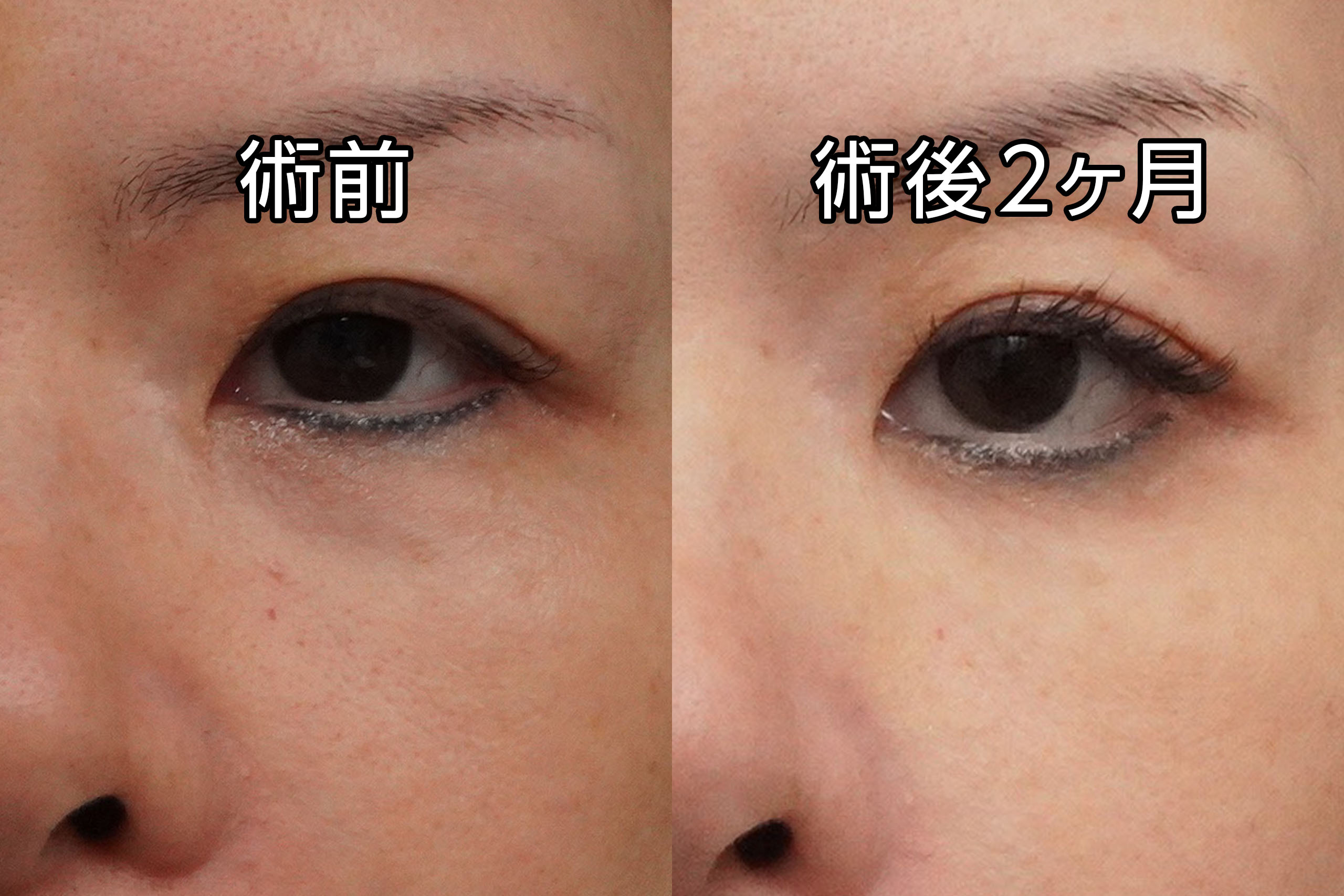 ★456　55歳女性 【他院修正】経結膜脱脂術＋マイクロCRF注入（目の下、中顔面、ほうれい線、オトガイ、マリオネットライン）