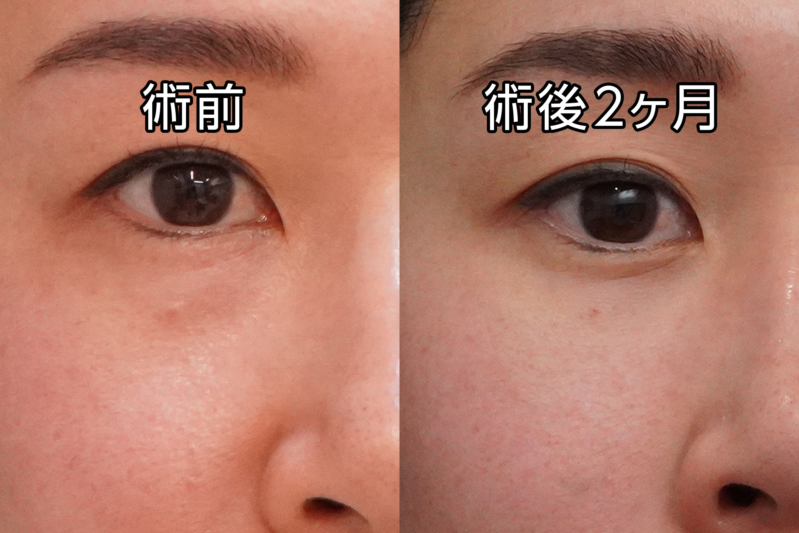 ★464　37歳女性　経結膜脱脂術＋マイクロCRF注入（目の下、中顔面、ほうれい線、オトガイ、マリオネットライン）＋頬アゴ下VASERアキーセル脂肪吸引