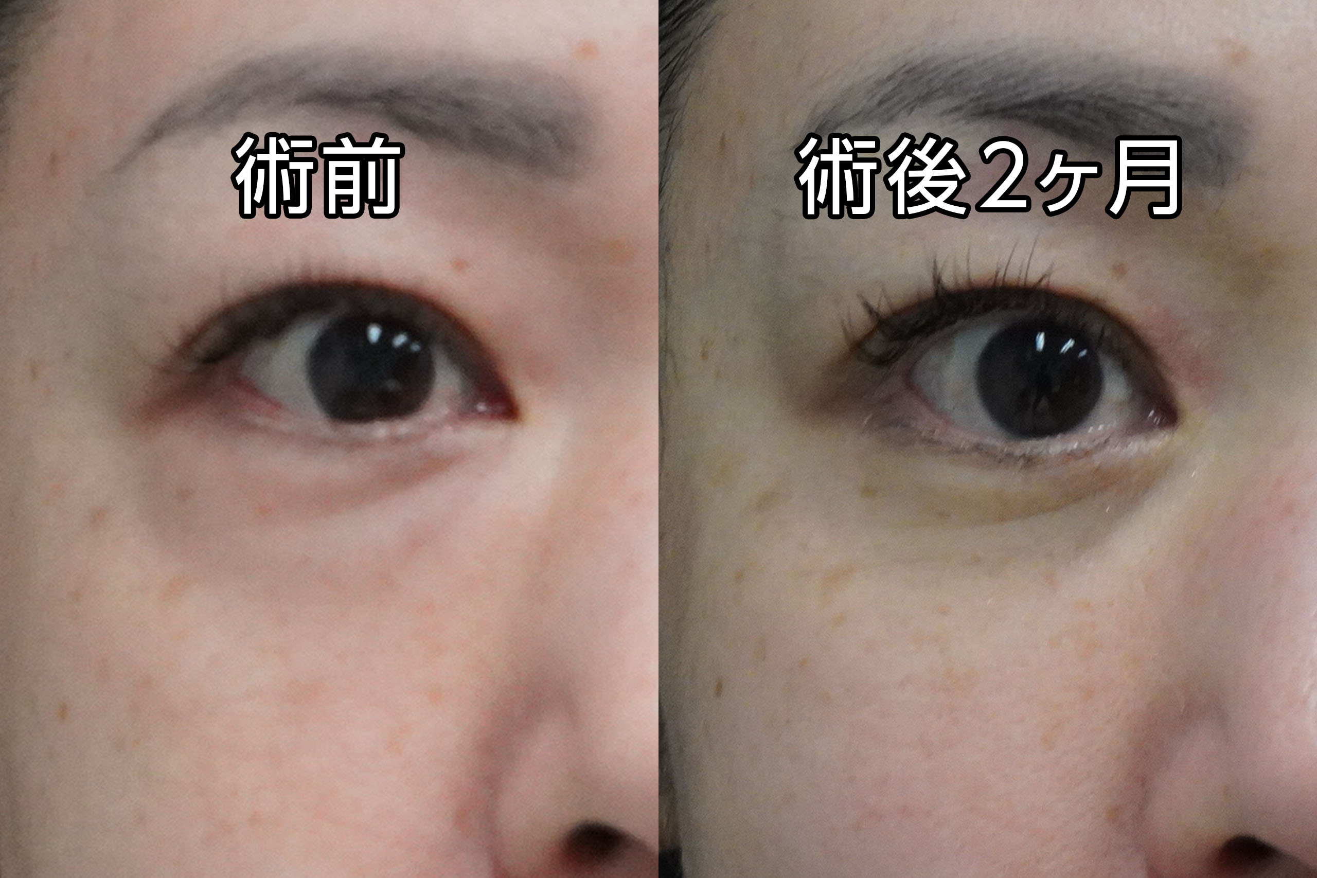 ★458　50歳女性　経結膜脱脂術＋マイクロCRF注入（目の下、中顔面、ほうれい線、オトガイ、マリオネットライン）