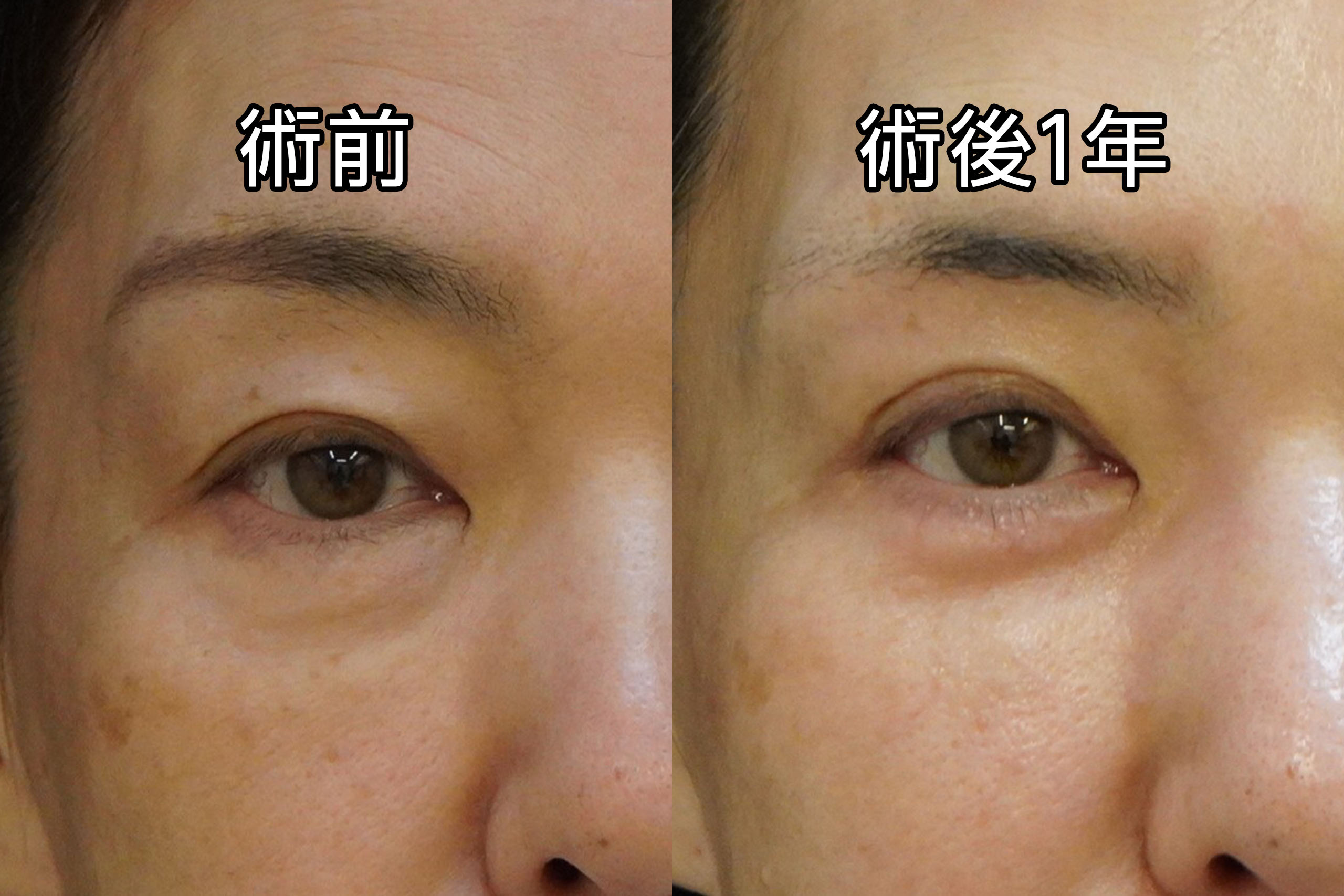 ☆35　★468　【劇的に若々しく！】63歳女性　経結膜脱脂術＋マイクロCRF注入（目の下、中顔面、ほうれい線）＋眉下切開＋上まぶたの脂肪除去＋下まぶた皮膚切開たるみ取り
