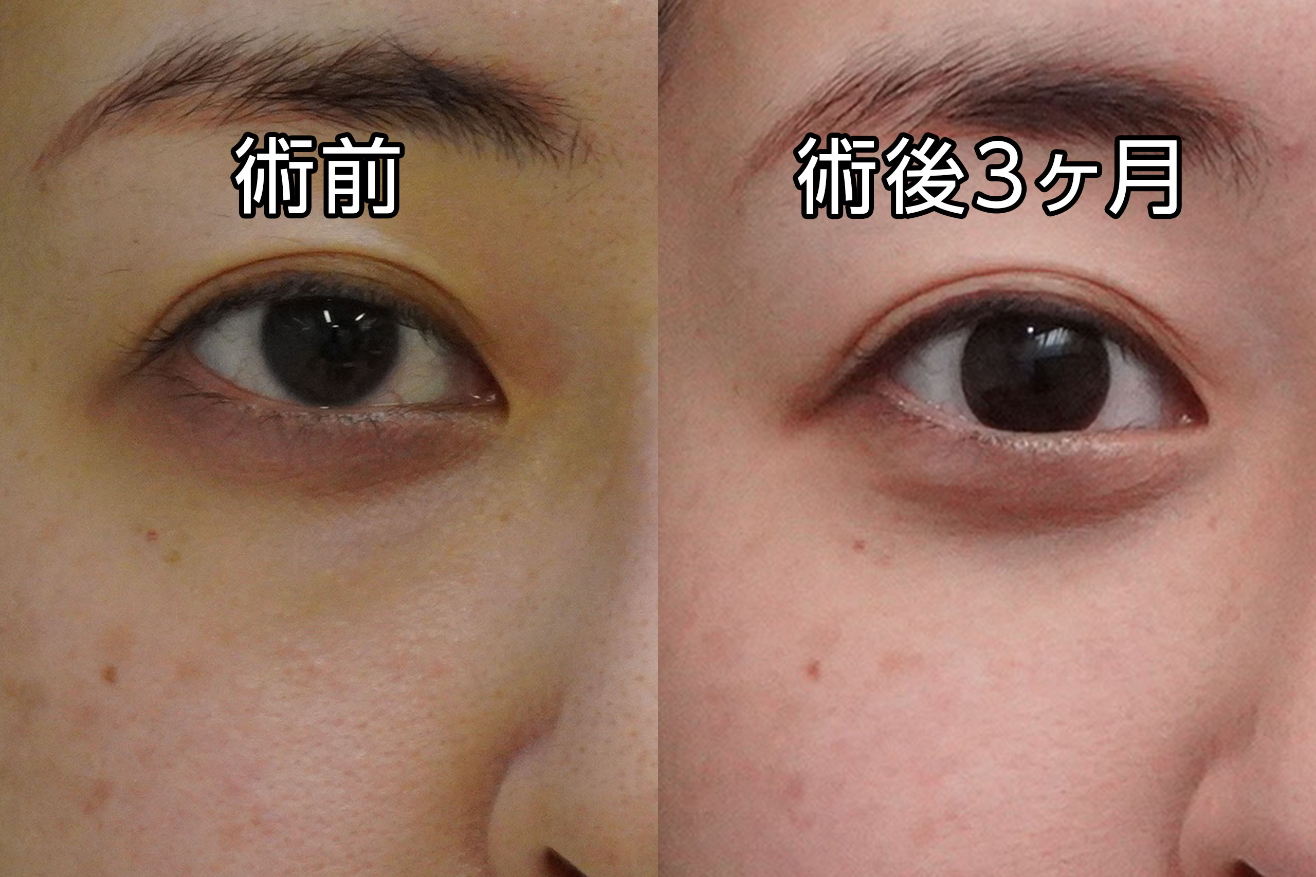 ★473　31歳女性　経結膜脱脂術＋眼窩脂肪注入