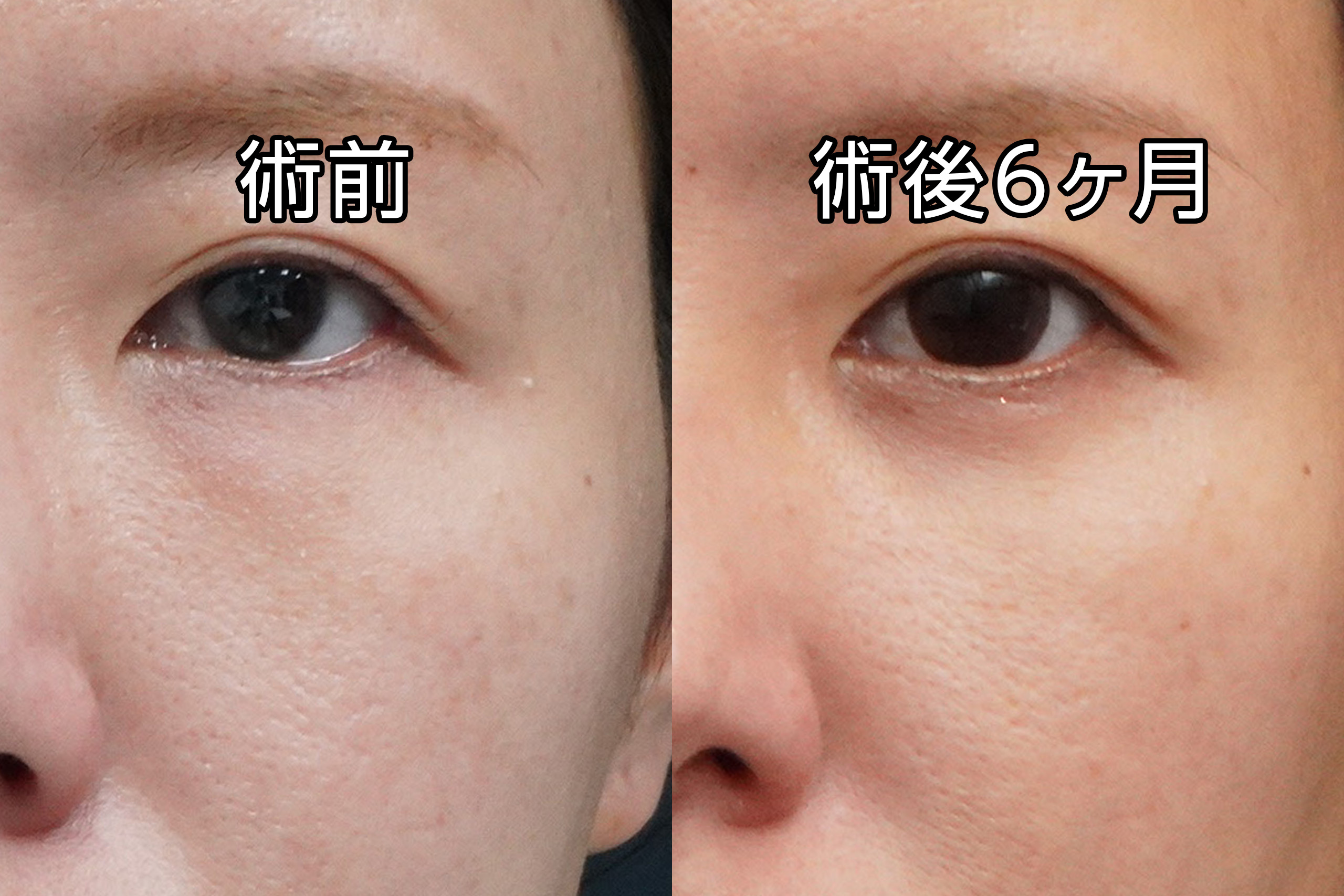 ★475　29歳女性　経結膜脱脂術＋マイクロCRF注入（目の下、中顔面、ほうれい線）＋ゴルゴ線剥離
