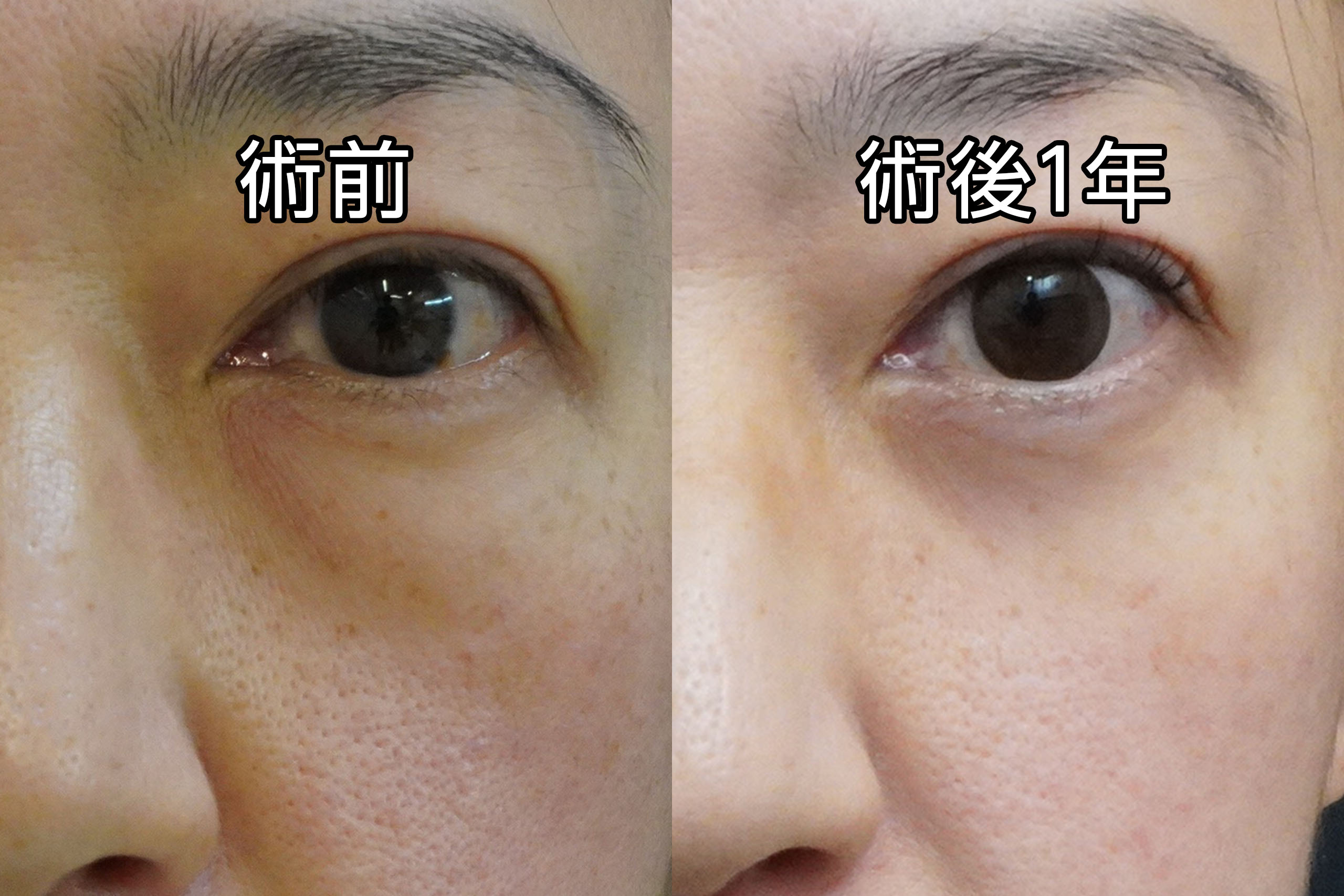 ★467　43歳女性　経結膜脱脂術＋マイクロCRF注入（目の下、中顔面、ほうれい線、オトガイ、マリオネットライン）＋頬アゴ下VASERアキーセル脂肪吸引
