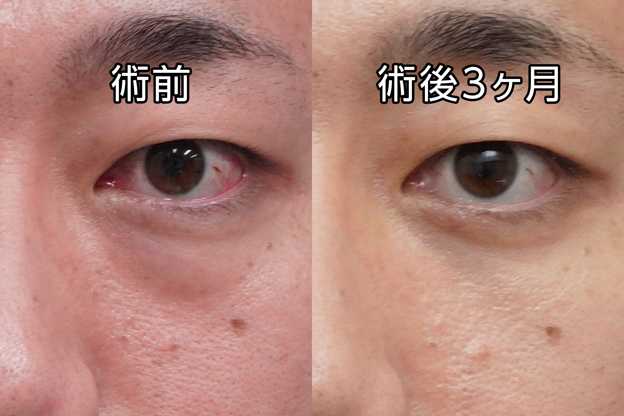 ★470　36歳男性　経結膜脱脂術＋眼窩脂肪注入
