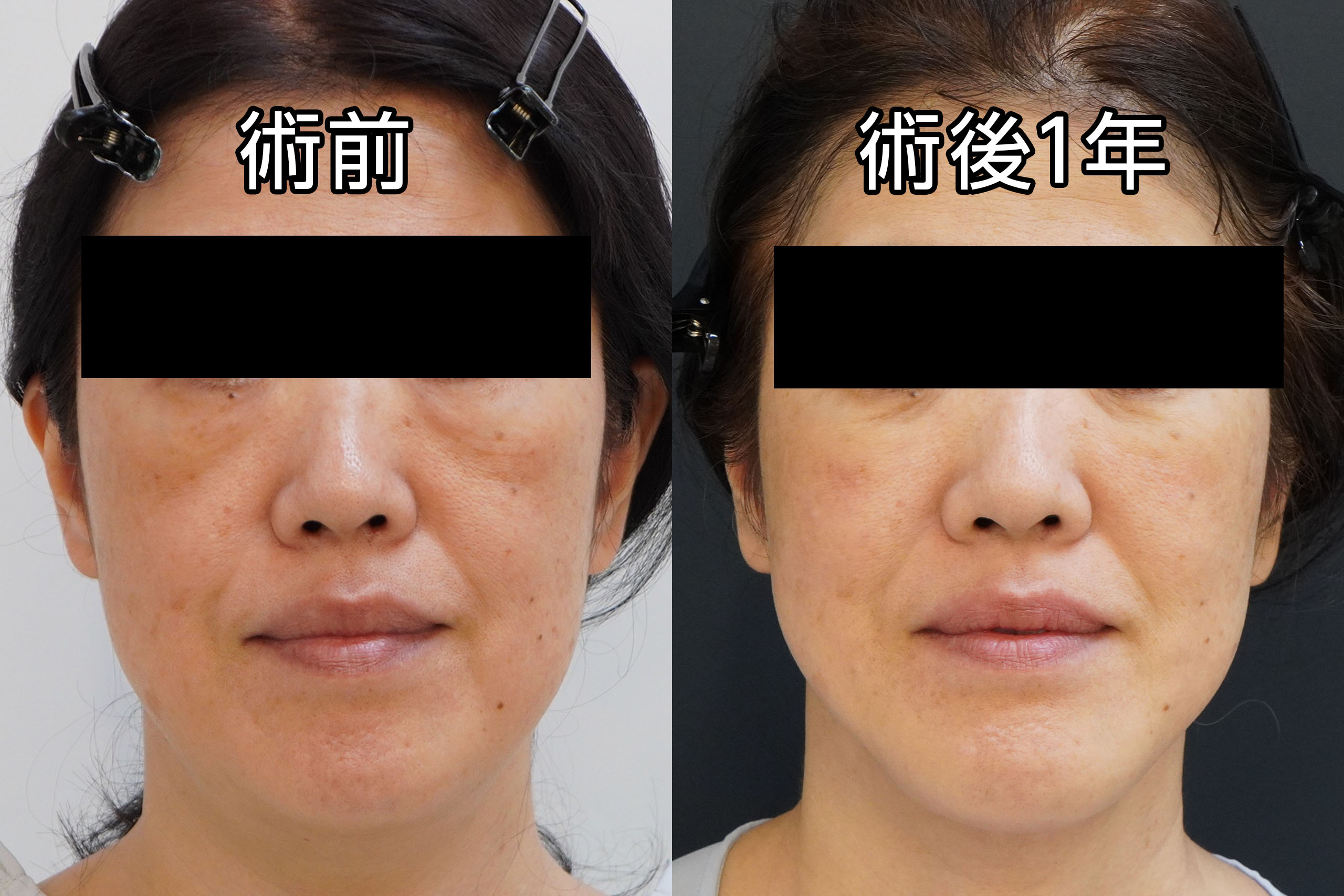 ★218　57歳女性　頬アゴ下VASER＋アキーセル脂肪吸引経結膜脱脂術＋マイクロCRF注入（目の下、中顔面、ほうれい線、オトガイ、マリオネットライン）