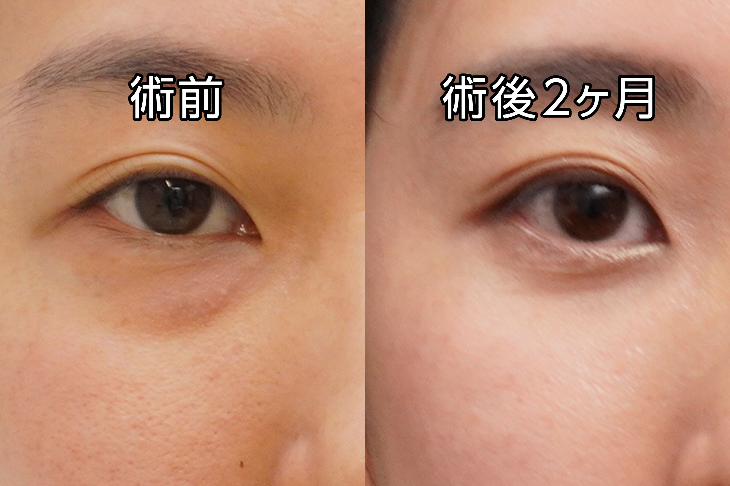 ★476　30歳女性　経結膜脱脂術＋眼窩脂肪注入