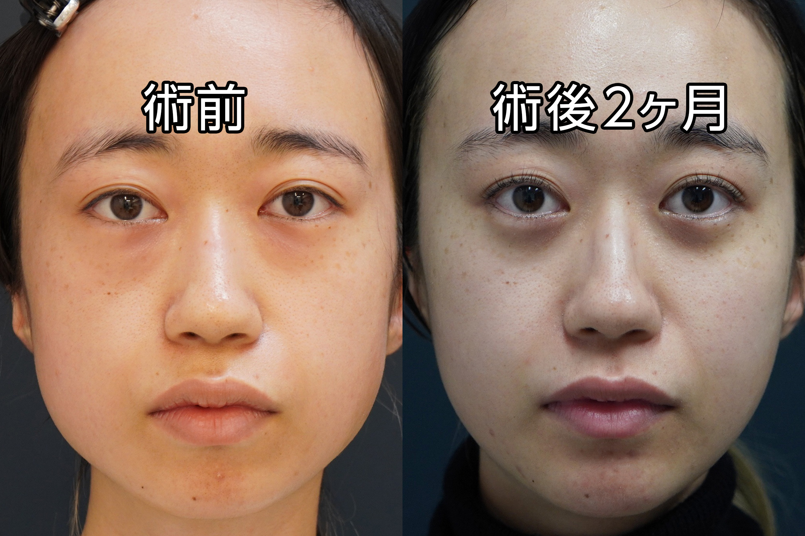 ★477　25歳女性　経結膜脱脂術＋マイクロCRF注入（目の下、中顔面）＋顎ヒアルロン酸注入＋エラボトックス【全顔モニター】
