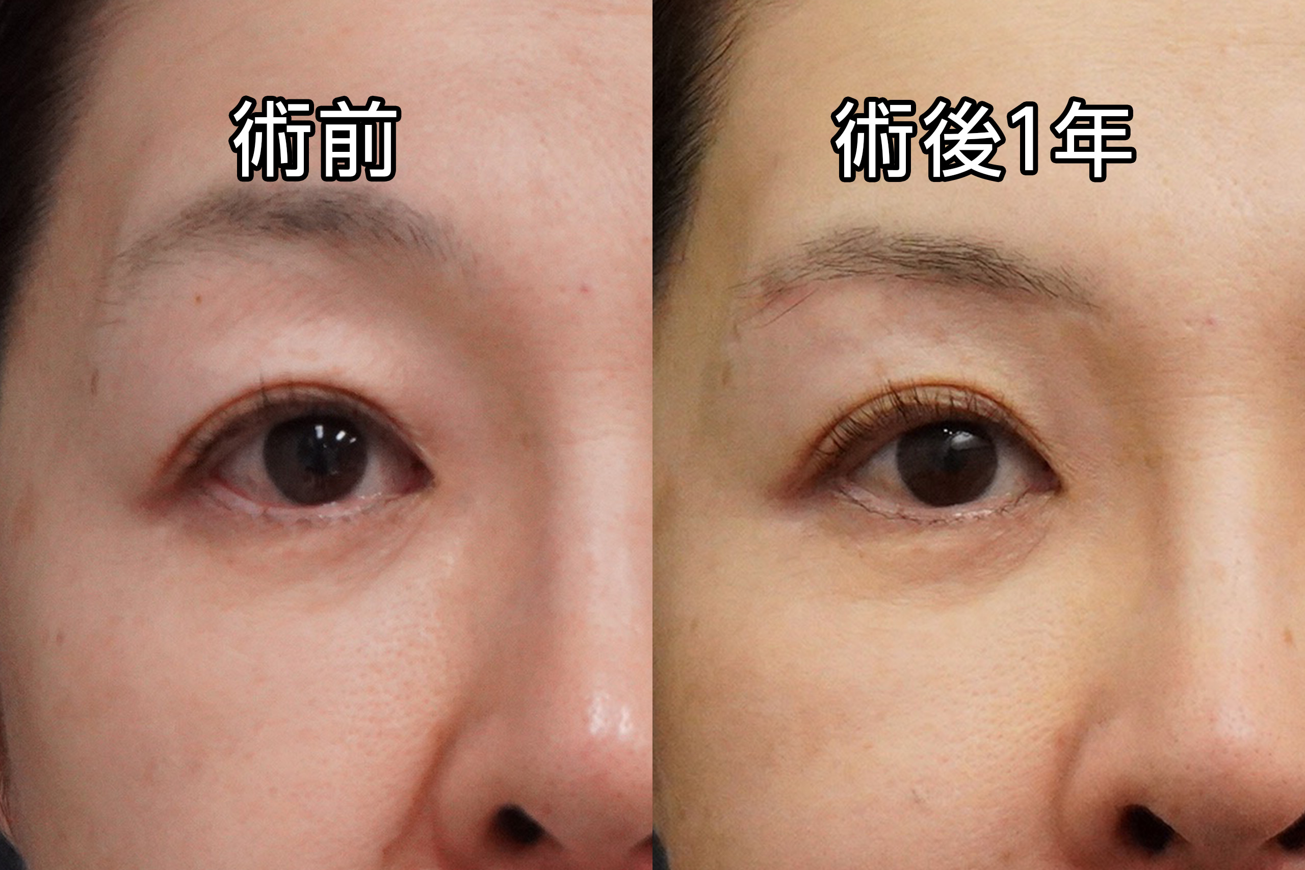 ☆38　50歳女性　眉下切開＋上瞼の脂肪除去（内側）