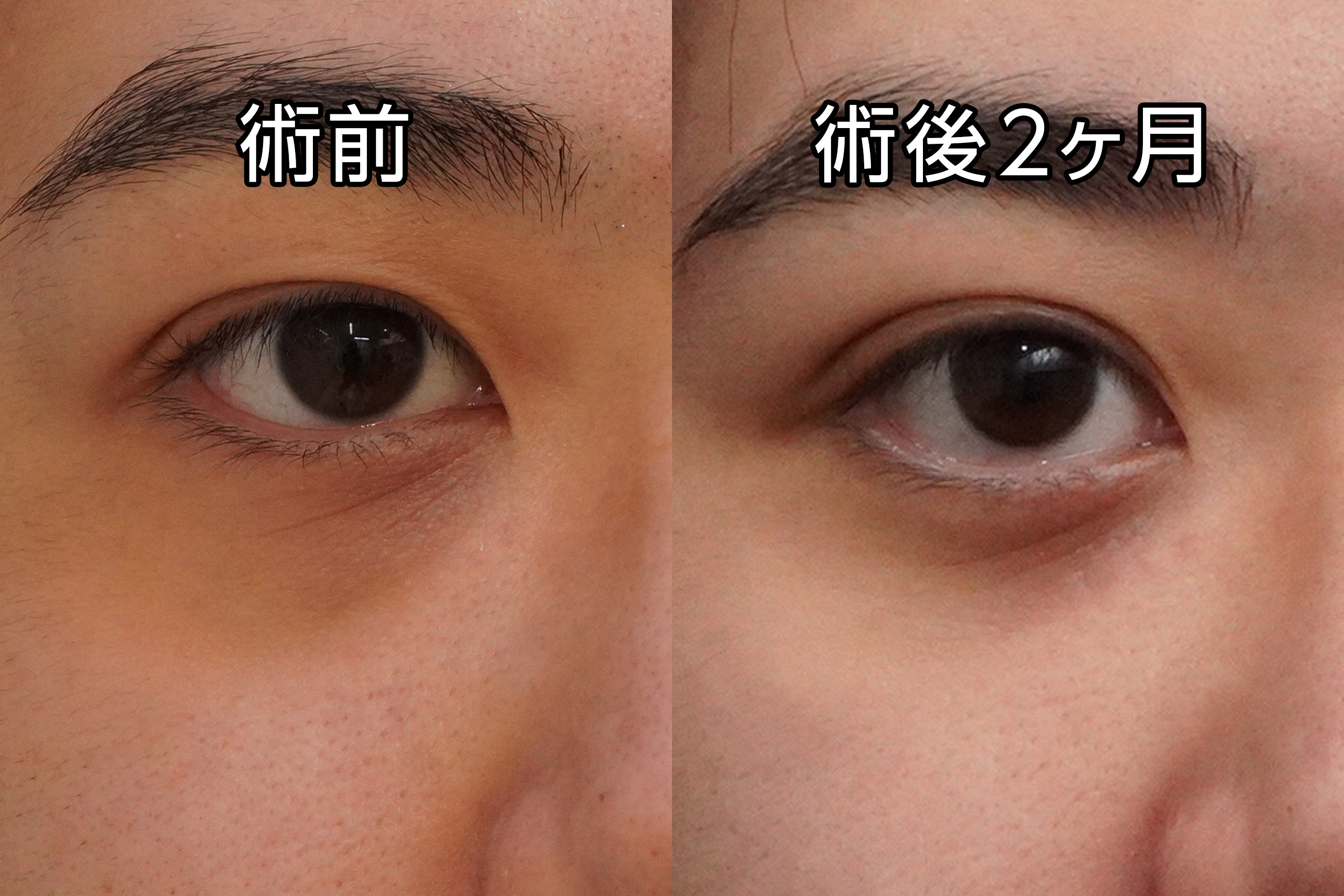 ★481　32歳男性　経結膜脱脂術＋眼窩脂肪注入＋二重埋没法（プレミアムクイック法 右側）