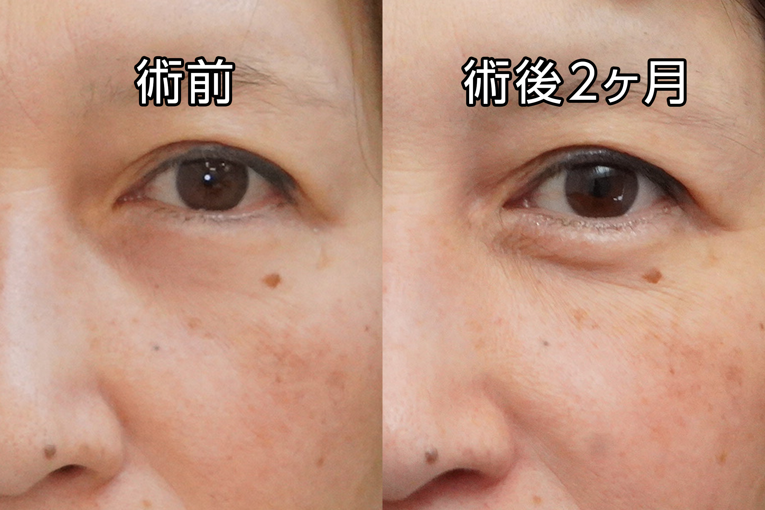 ★486　51歳女性　経結膜脱脂術＋マイクロCRF注入（目の下、中顔面、ほうれい線、オトガイ、マリオネットライン）