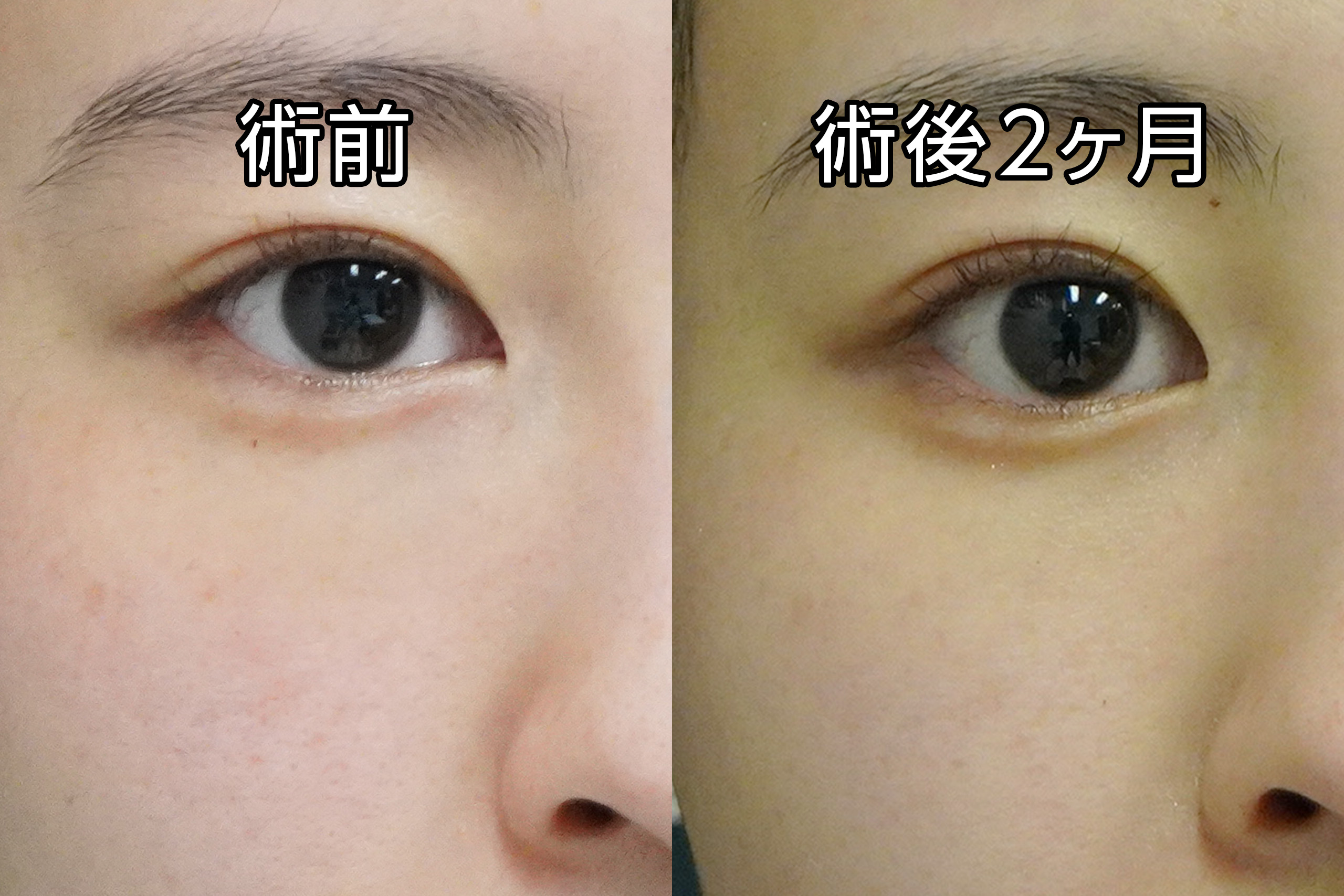 ★482　25歳女性　経結膜脱脂術＋マイクロCRF注入（目の下、中顔面、ほうれい線）