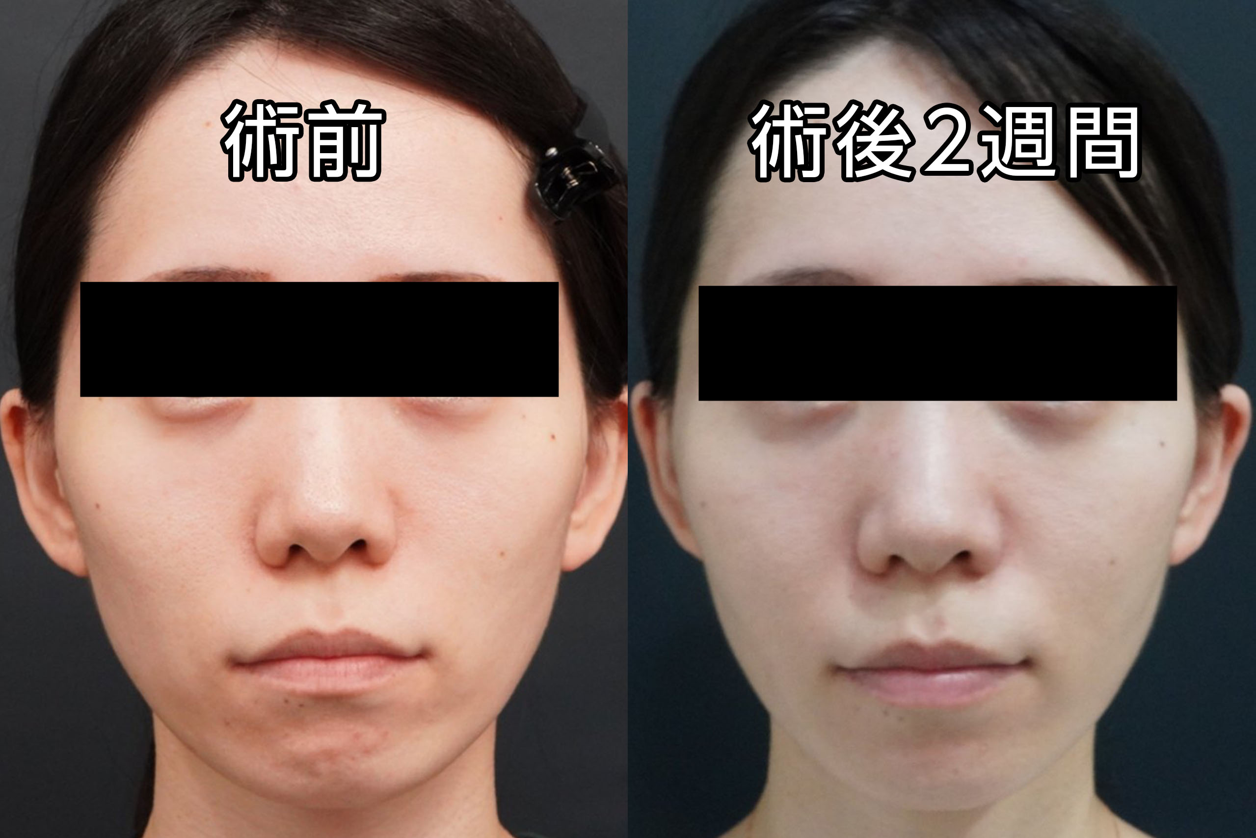 31歳女性　中顔面へのヒアルロン酸注入（ボリフト）　3本でふっくら可愛らしく