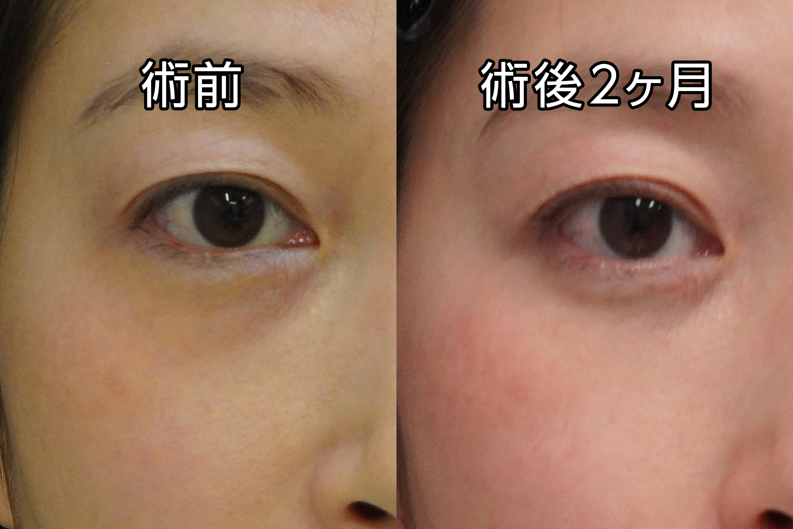 ★485　42歳女性　経結膜脱脂術＋マイクロCRF注入（目の下、中顔面、ほうれい線）