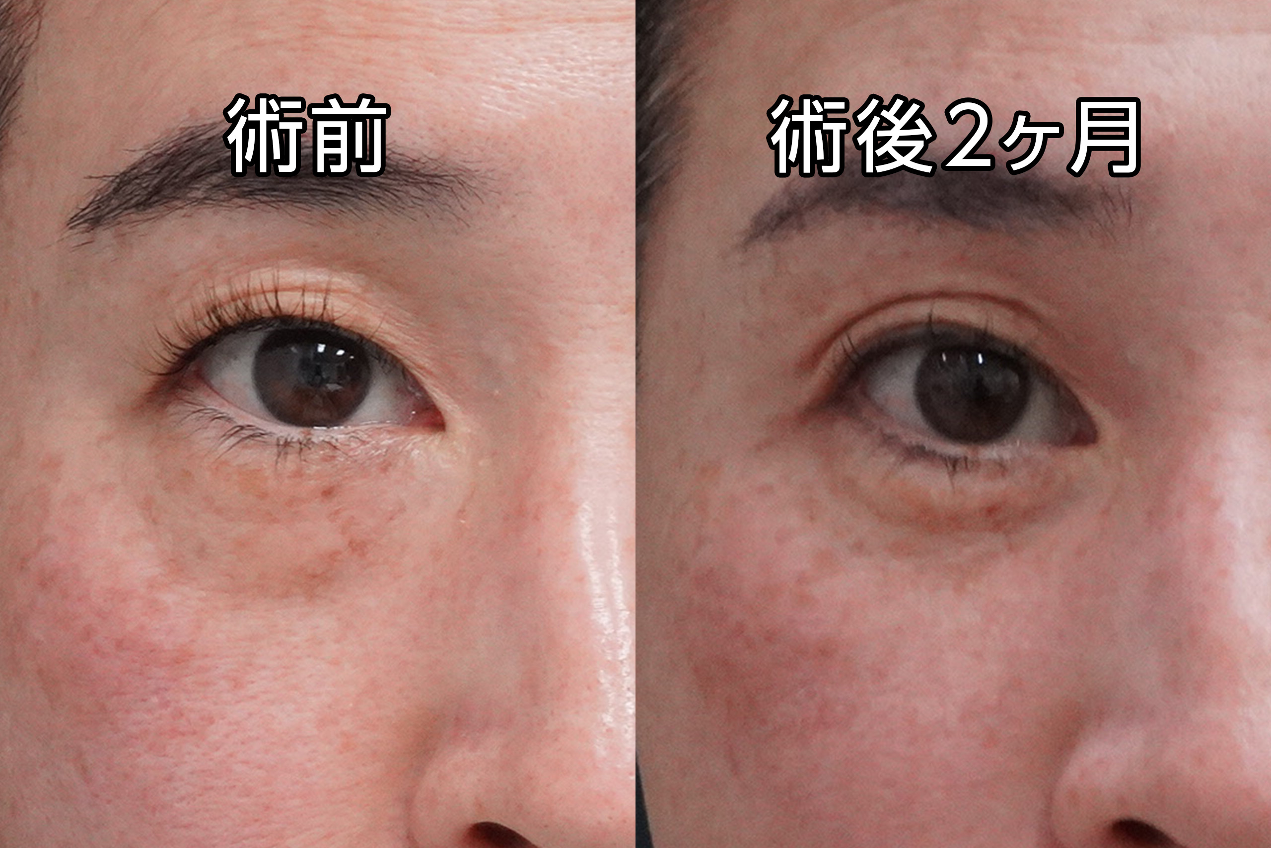 ★484　50歳女性　ヒアルロン酸溶解→経結膜脱脂術＋マイクロCRF注入（目の下、中顔面、ほうれい線）