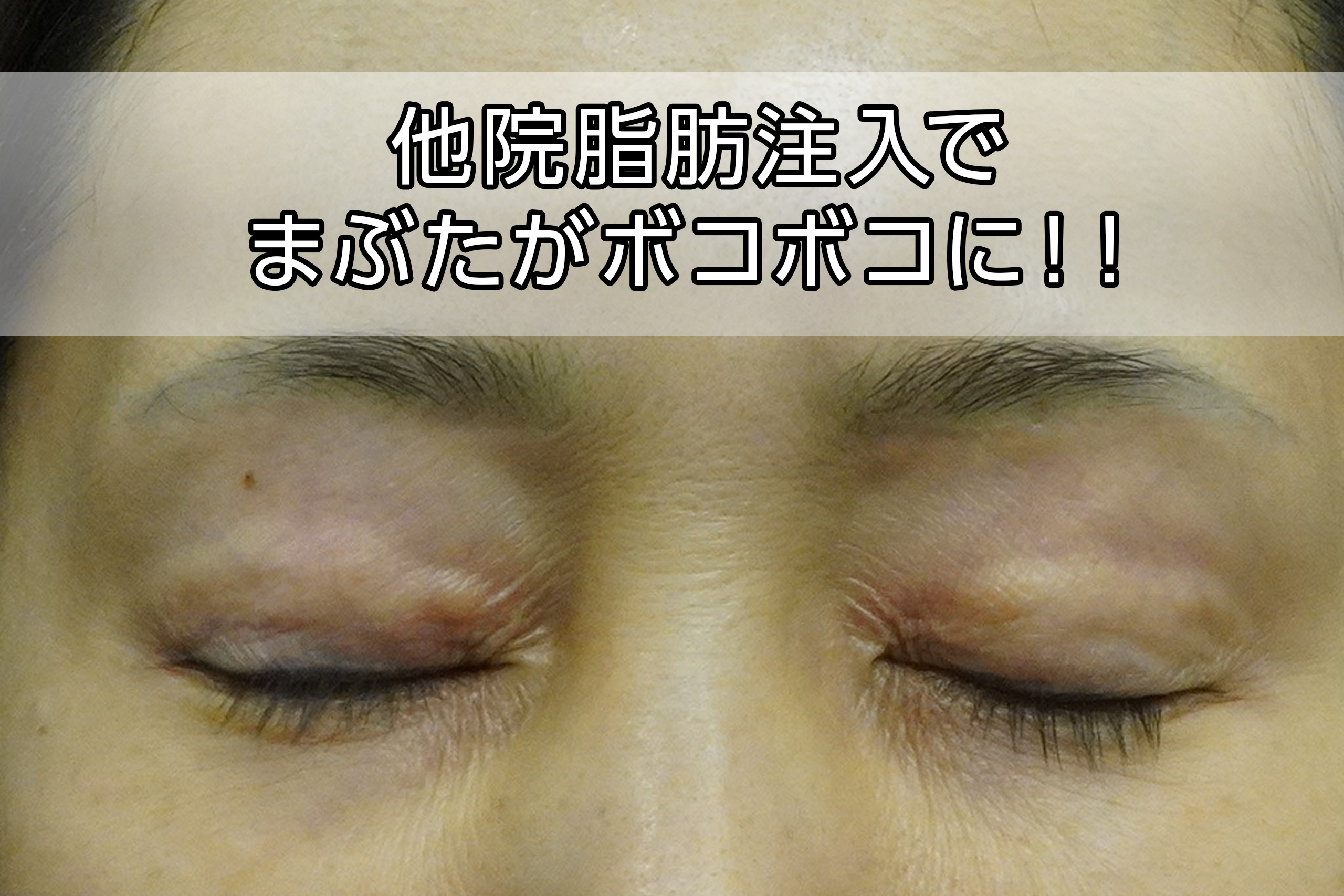 ☆37-2　★483-2　48歳女性　【他院脂肪注入でまぶたがボコボコに！！】眉下切開→経結膜脱脂術＋眼窩脂肪注入