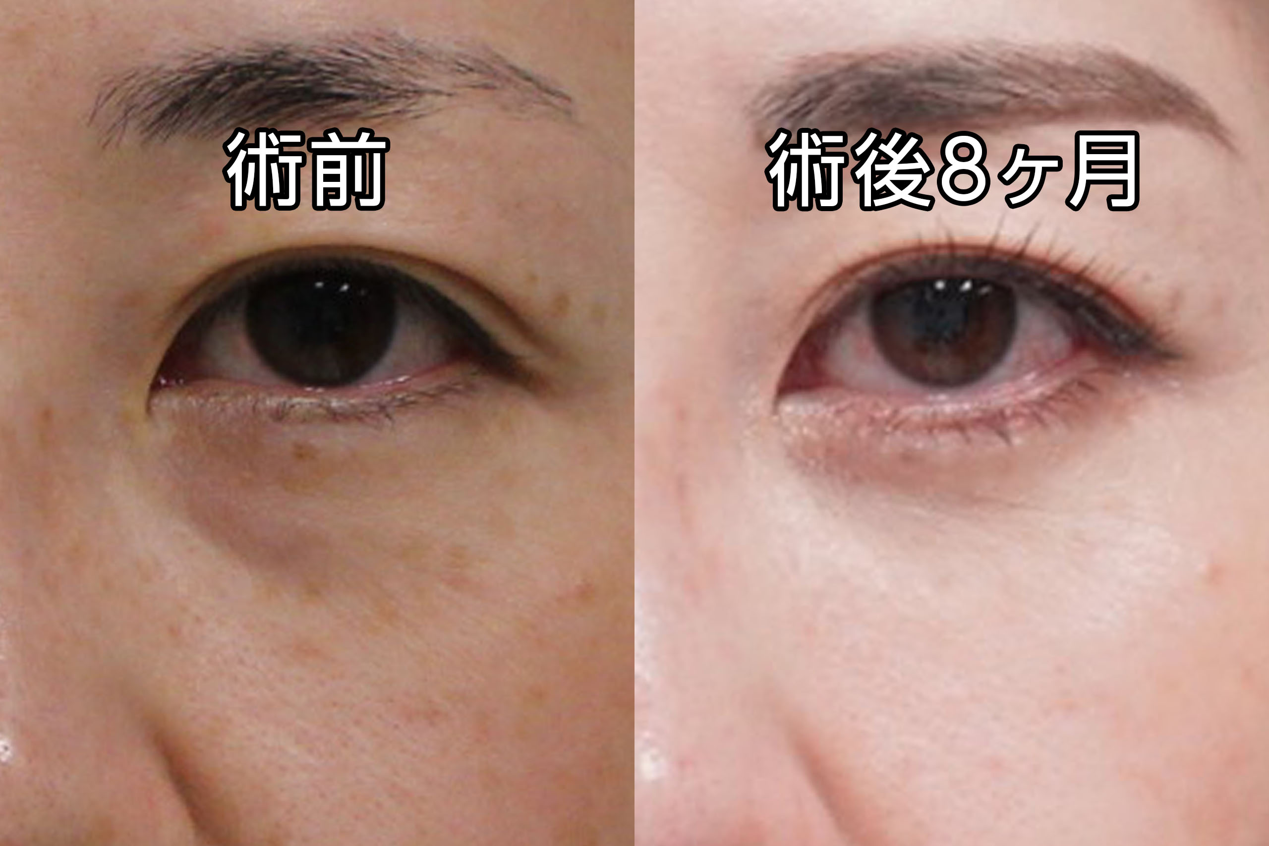 【隠れ涙袋】★232-2　36歳女性　経結膜脱脂術+眼窩脂肪注入　シミQ-スイッチYAGレーザー