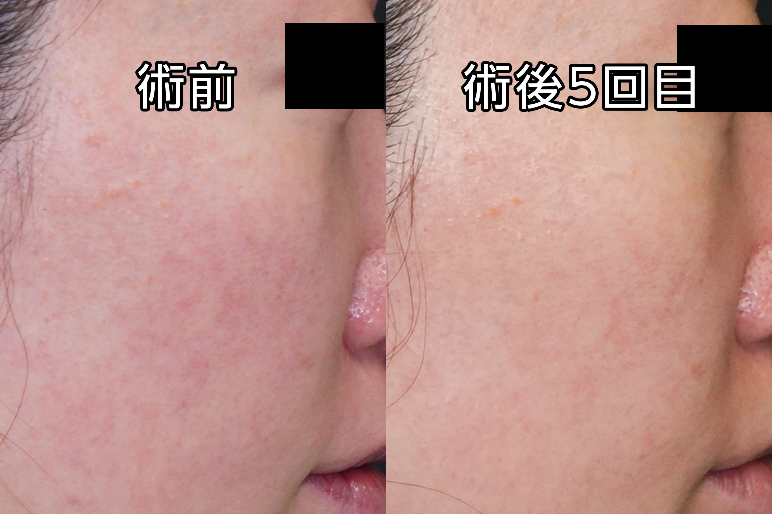 33歳女性　ポテンツァSチップで毛穴・赤みを改善