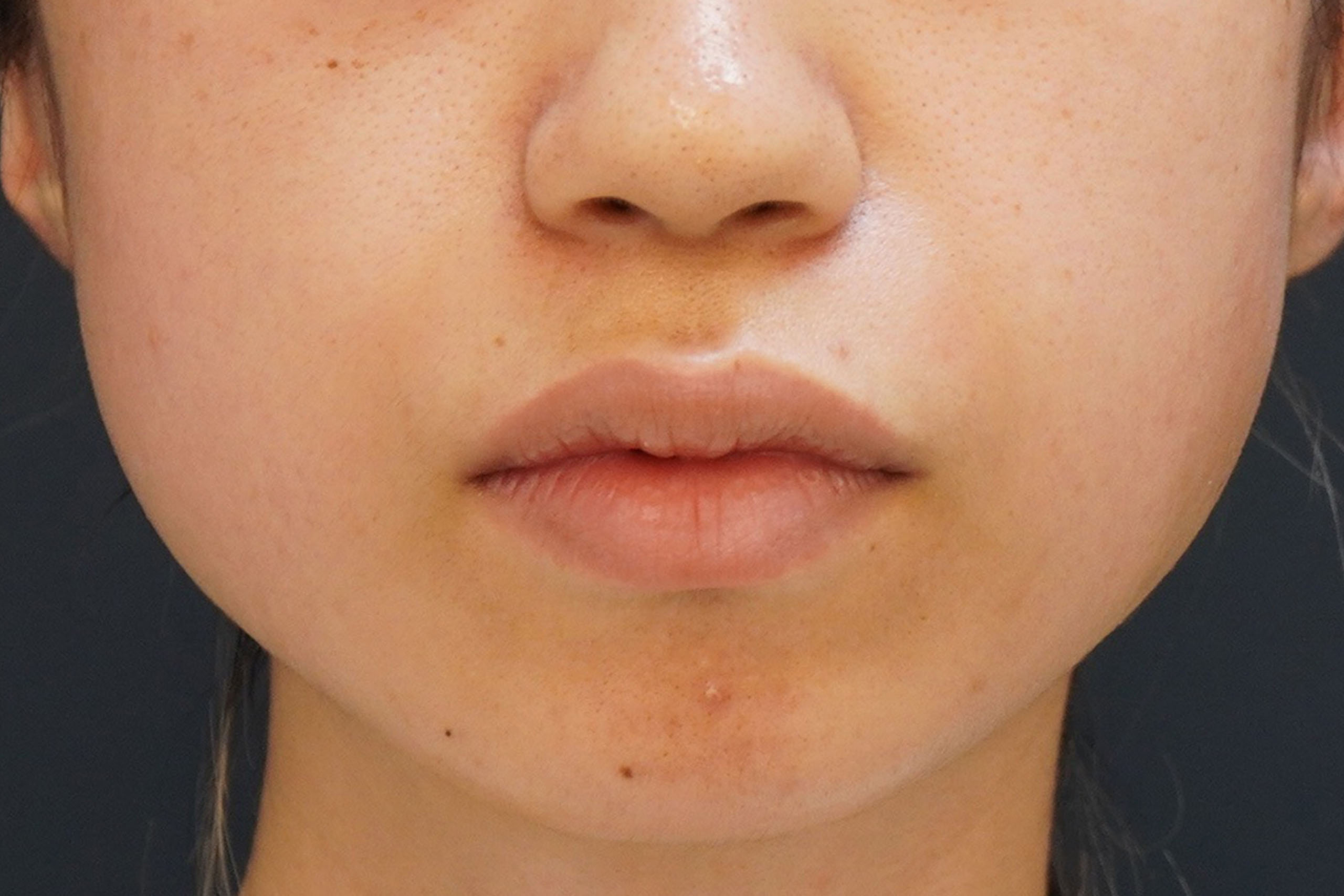 25歳女性　顎ヒアルロン酸注入＋エラボトックス＋経結膜脱脂術＋マイクロCRF注入（目の下、中顔面）