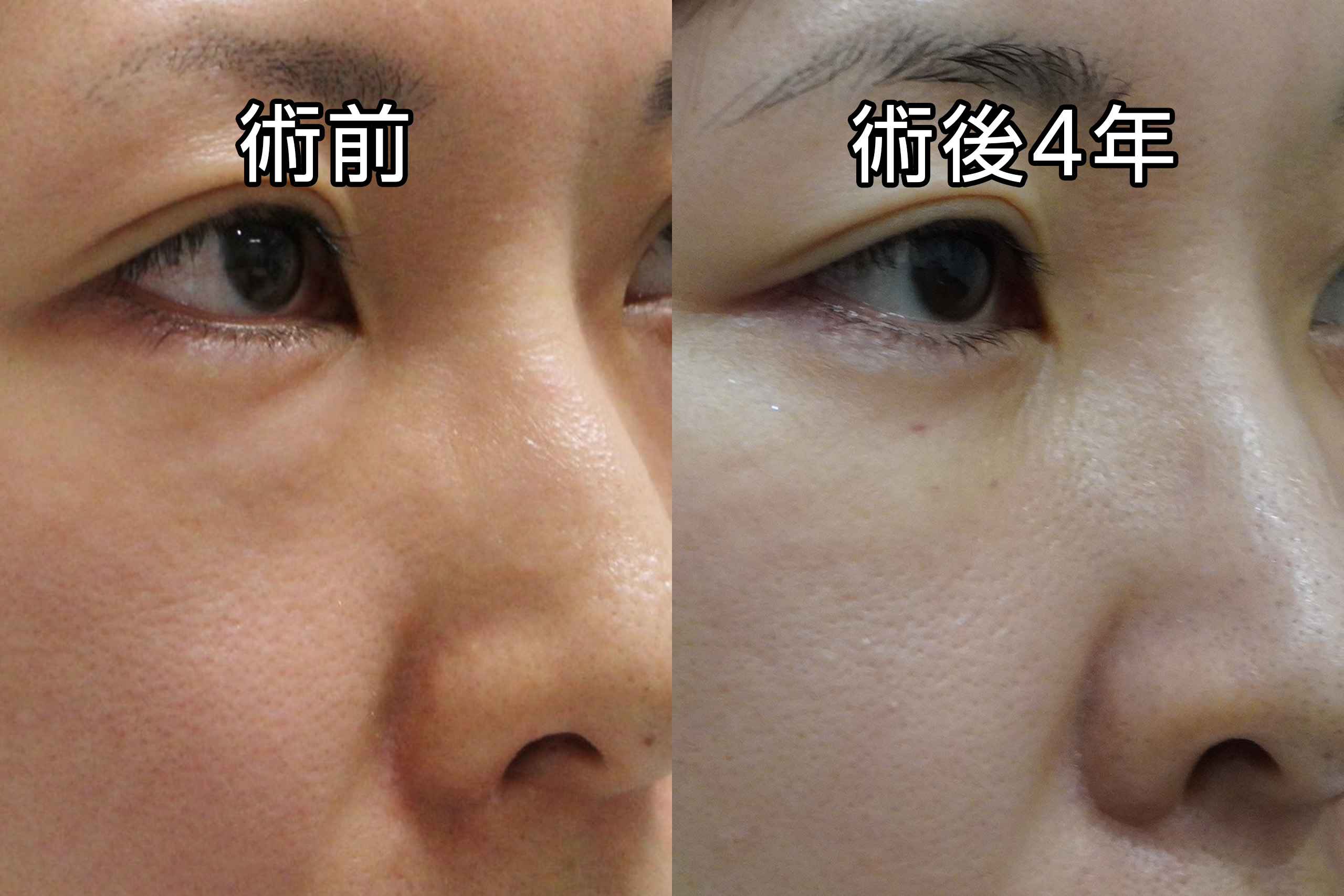 ★157-2　【4年後】34歳女性　経結膜脱脂術+マイクロコンデンスリッチファット　美顔に！！