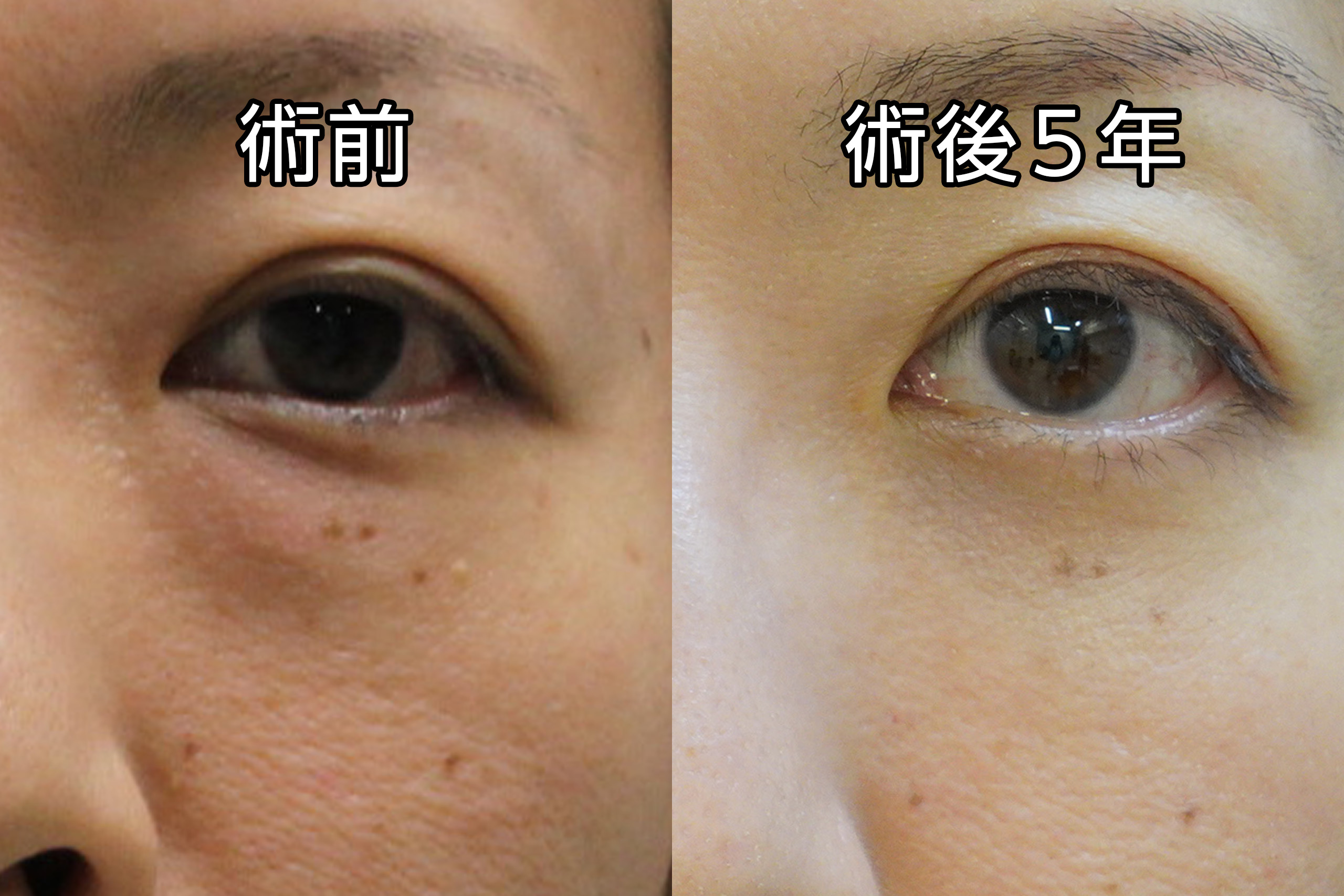★139-2　【術後5年】43歳女性　経結膜脱脂術＋マイクロCRF注入（目の下、中顔面）＋ヒアルロン酸注入（アゴ　ボリューマXC）